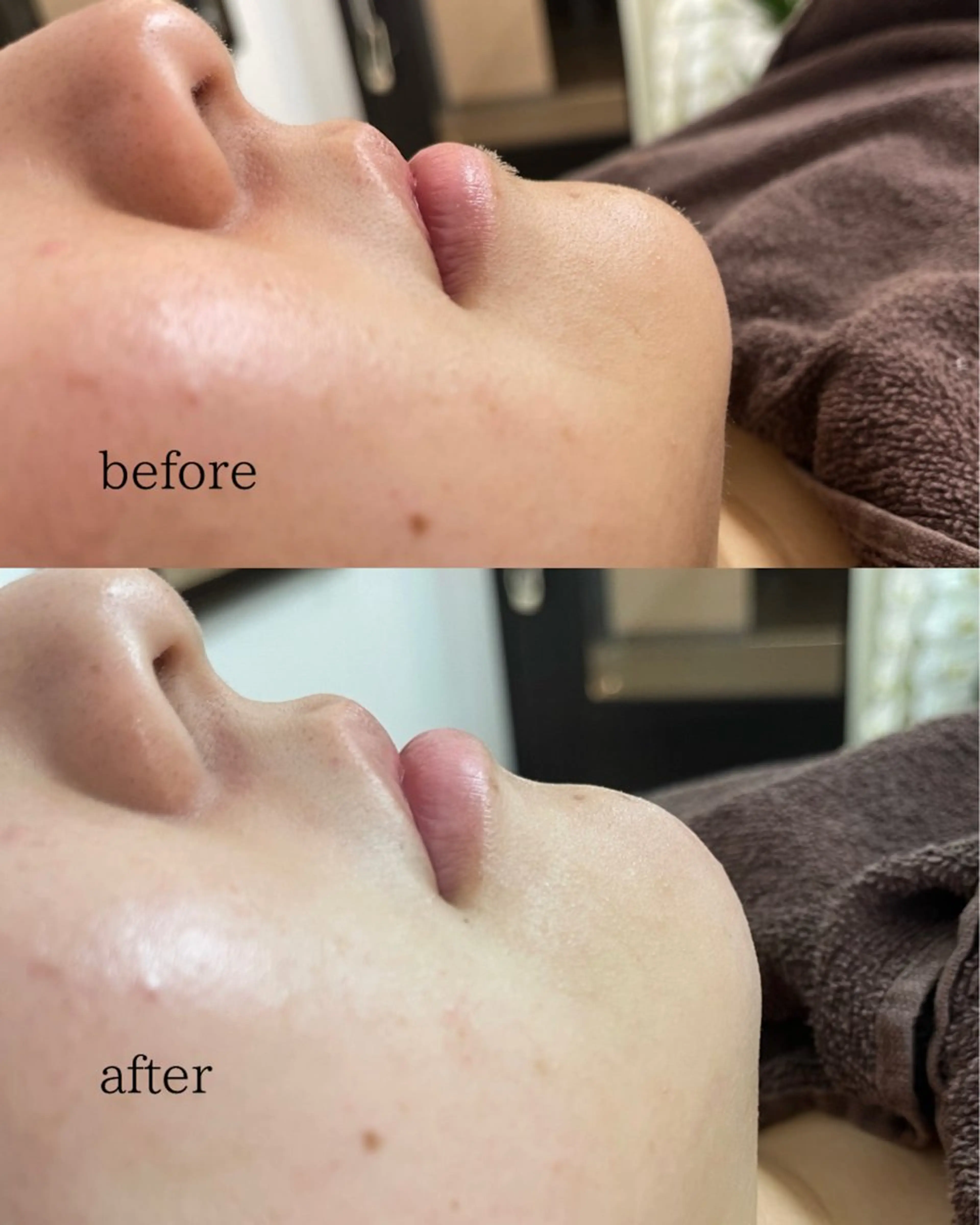 【ミニモ限定】クレンジングマッサージ+お顔剃り＋ヘッドスパ10分＋プラセンタパック付き♪の写真