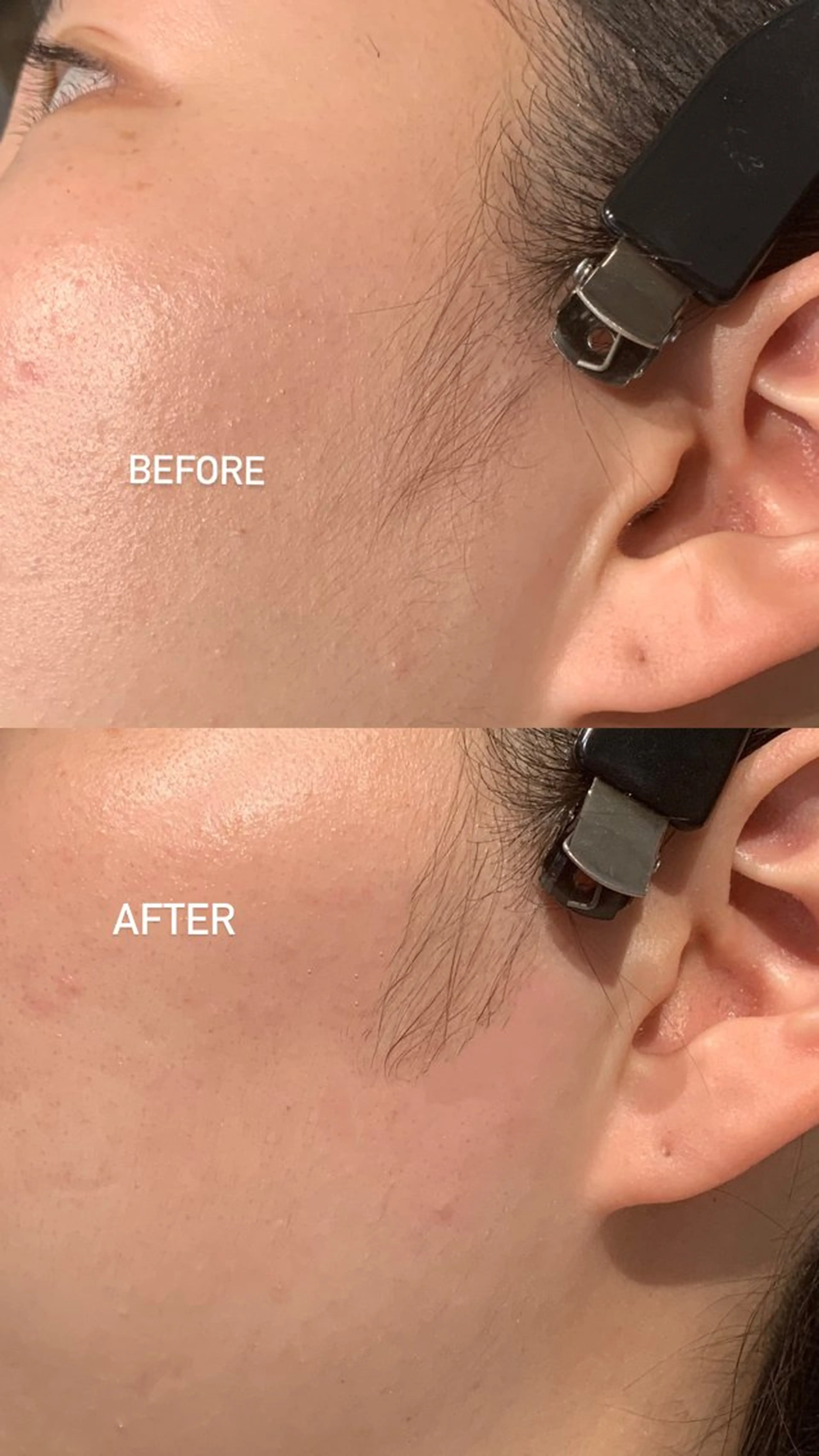 メンズ アイブロウ 眉毛ワックス脱毛 iBROW. 熊見怜奈の眉毛・アイブロウイメージ