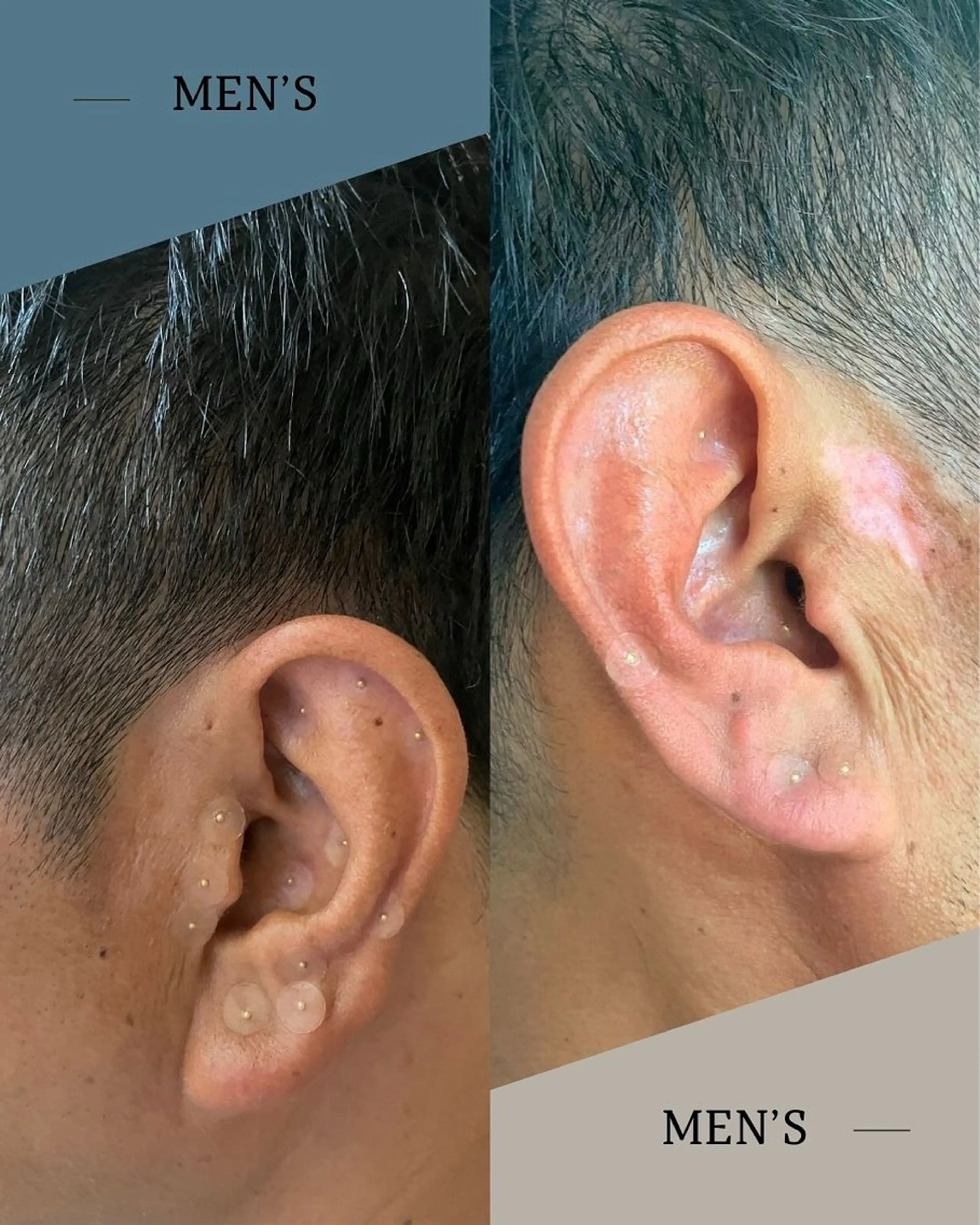 mimine エメラルド式耳つぼのその他イメージ