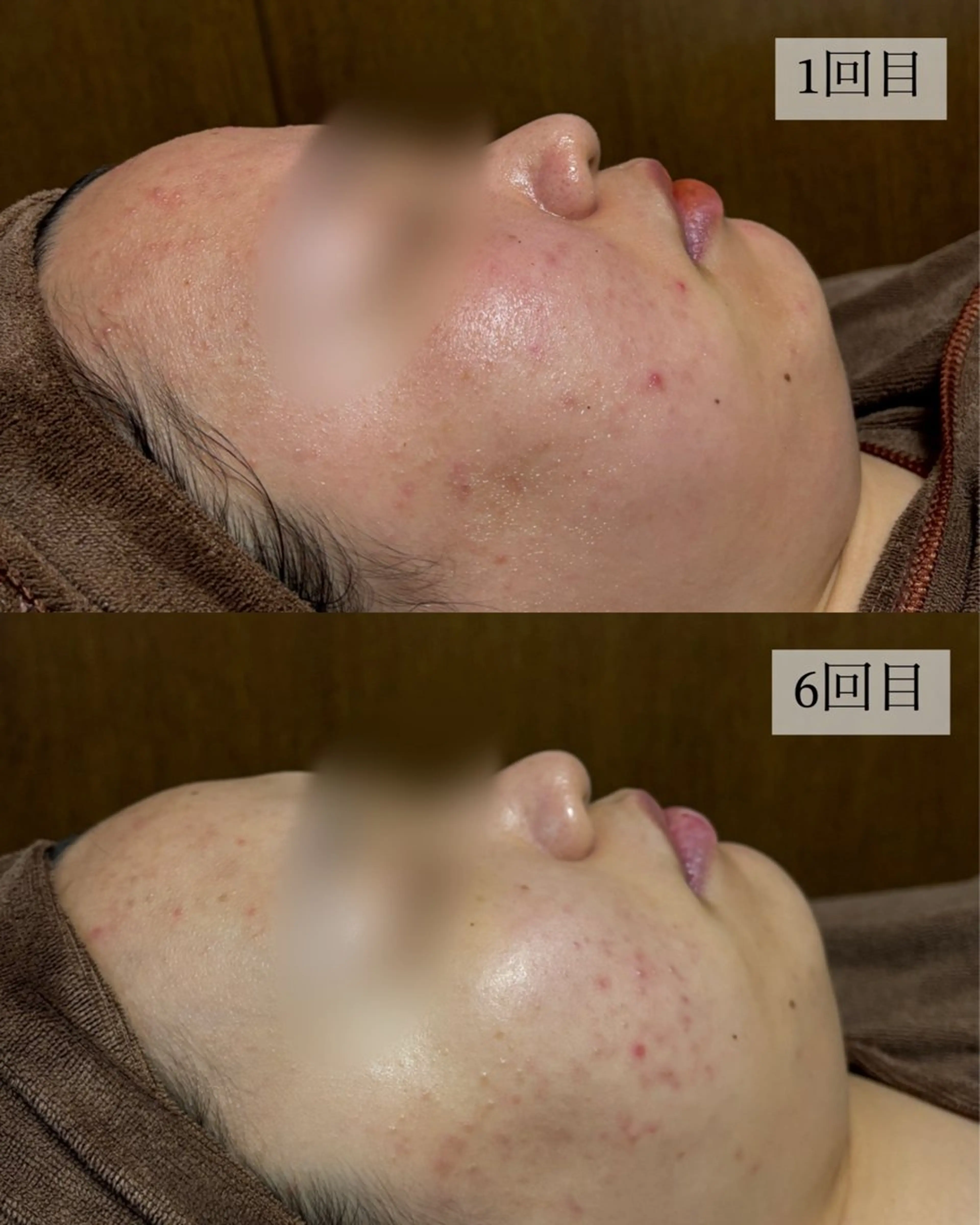 HINANO矢場町店【ヒナノ】所属・脱毛/肌改善🌿 HINANO 村田のエステ・リラクイメージ