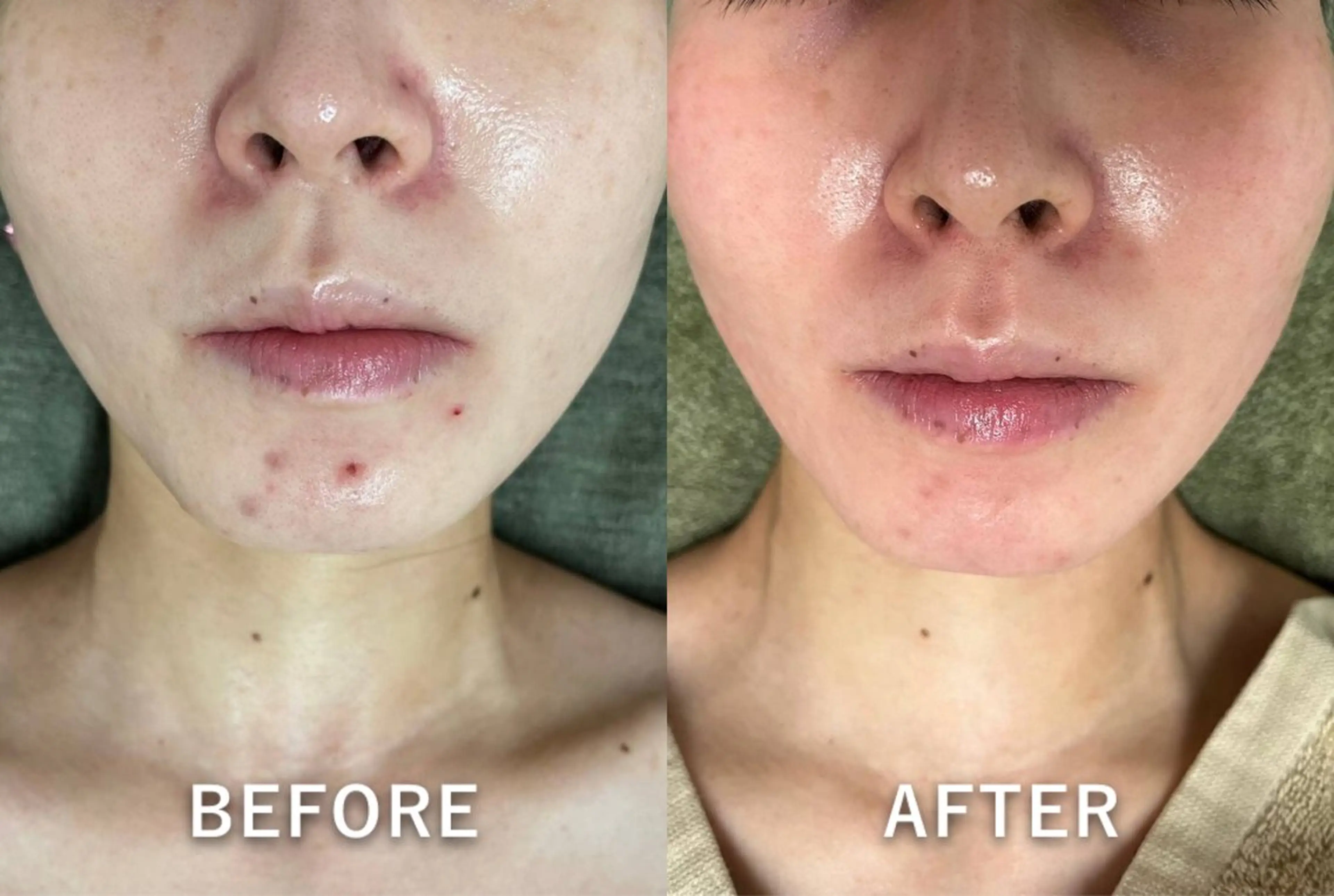 韓国美肌/肌質改善 【天神】yuiのエステ・リラクイメージ