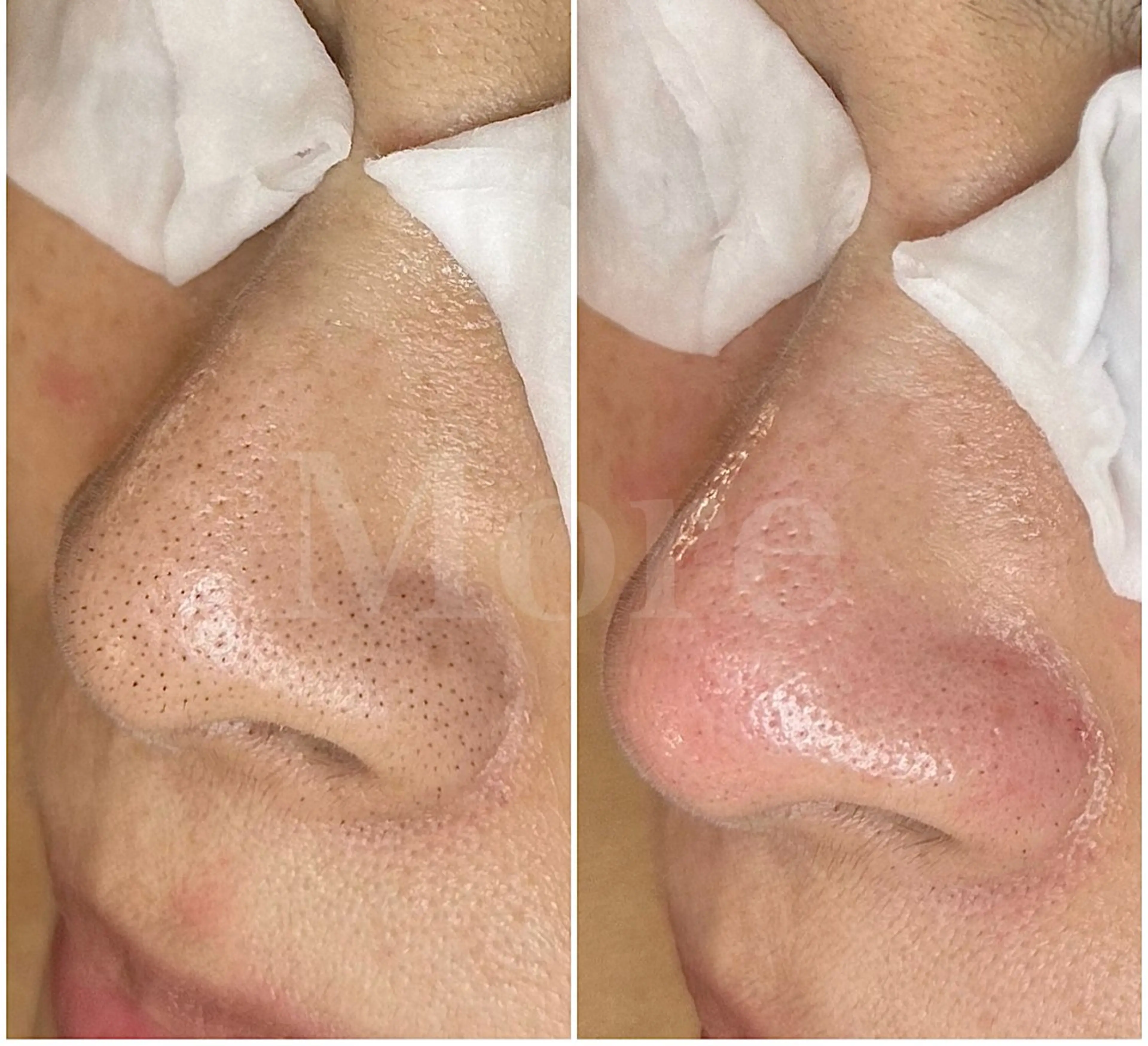 エステ salon de beauté More所属・More 大阪福島区 毛穴・肌質改善のエステ・リラクイメージ