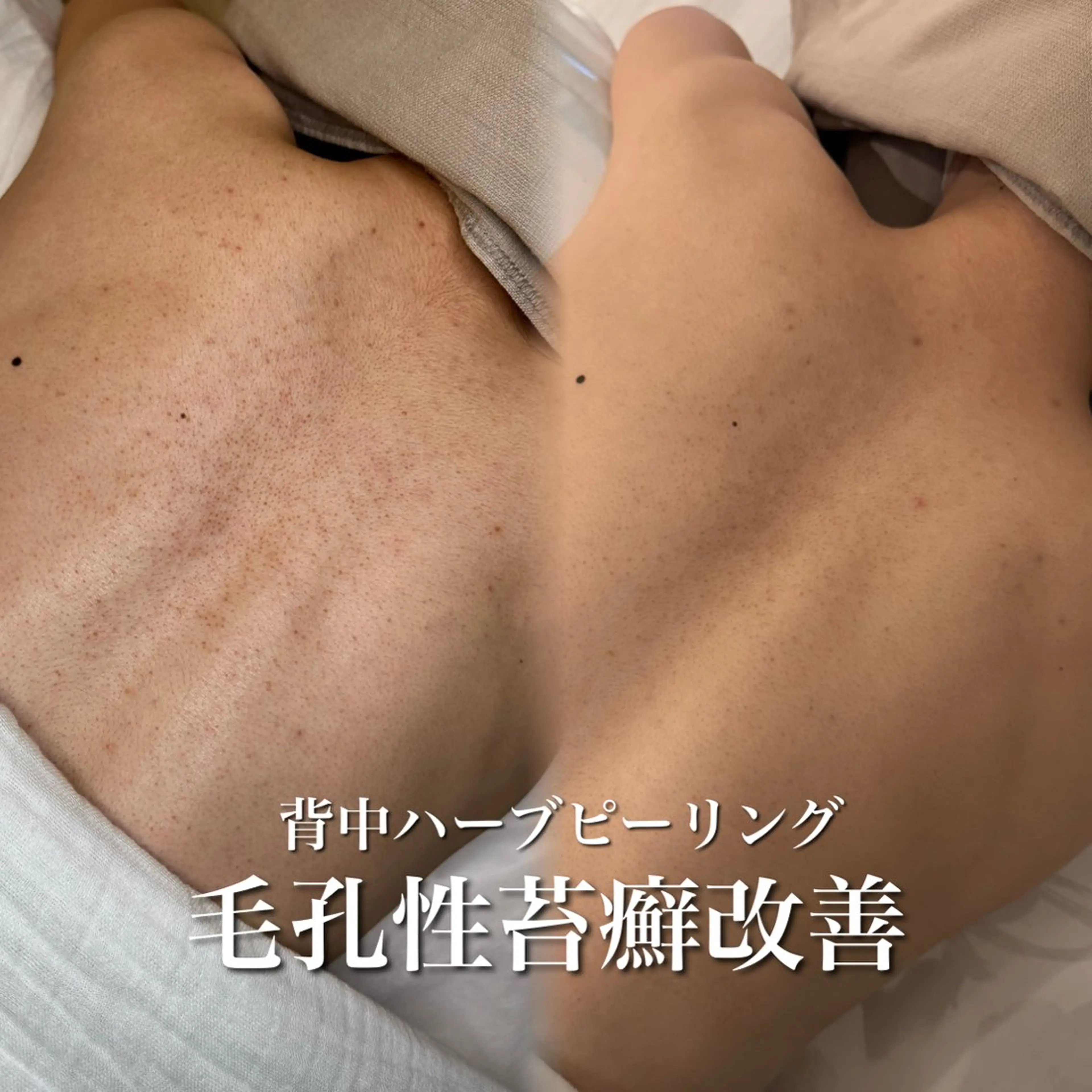 自信が持てる背中へ✨ブツブツ・ざらつき撃退✊剥ける背中のハーブピーリング🌿の写真