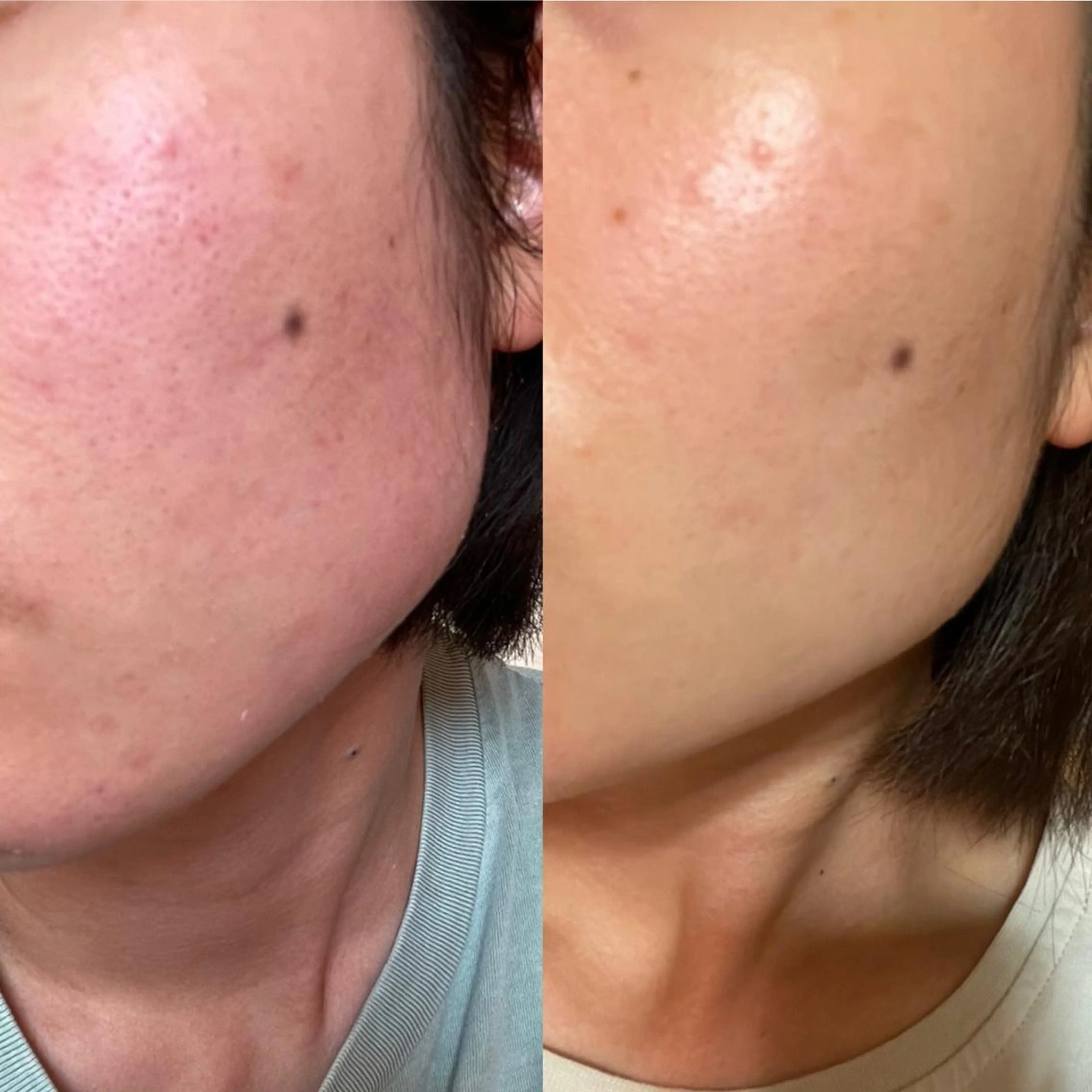 ハイドラ毛穴洗浄+アゼライン酸イオン導入の写真