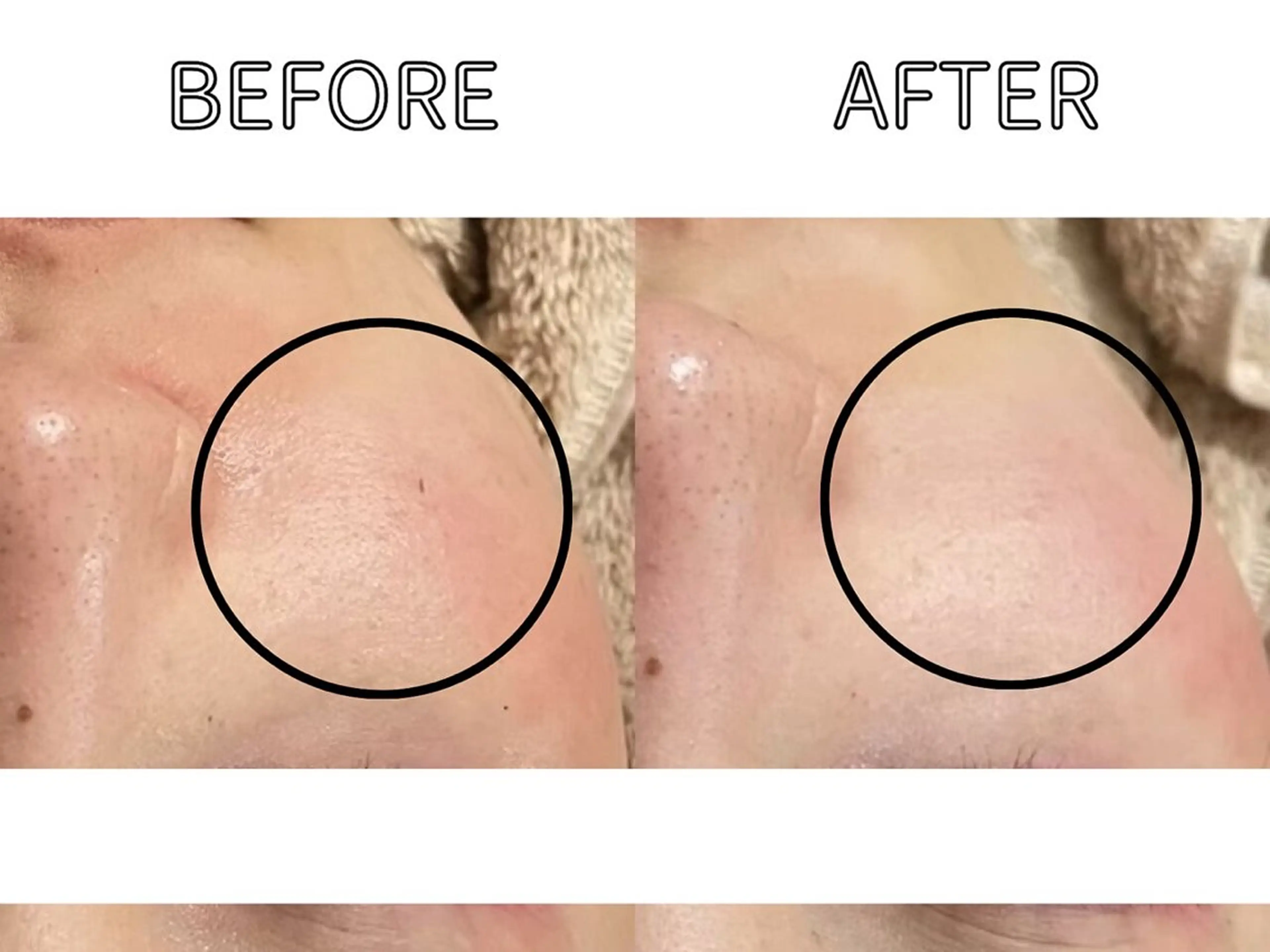 ハーブピーリング LIME池袋東口のエステ・リラクイメージ