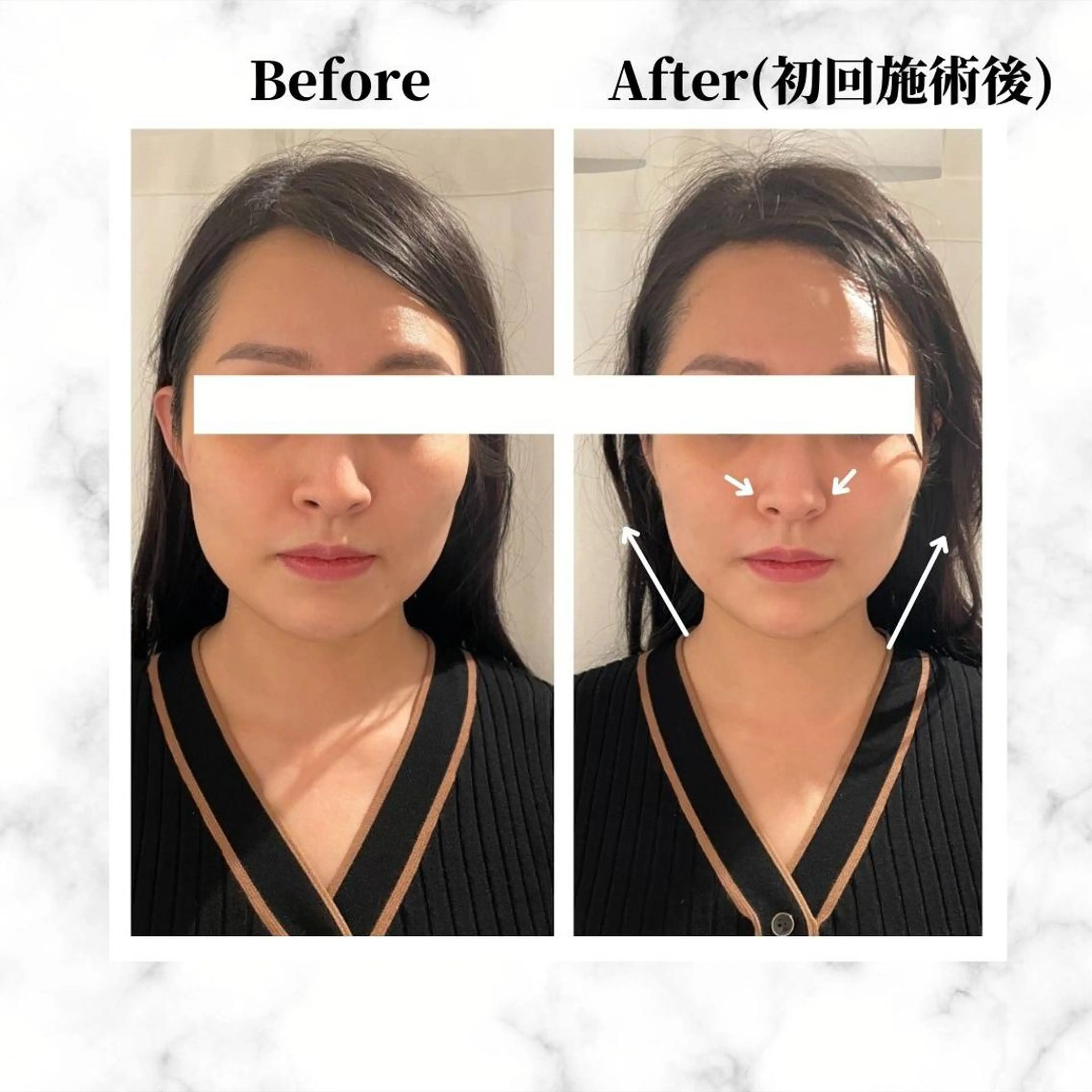 エステ リラク 12Dハイフ💗 最強小顔のエステ・リラクイメージ