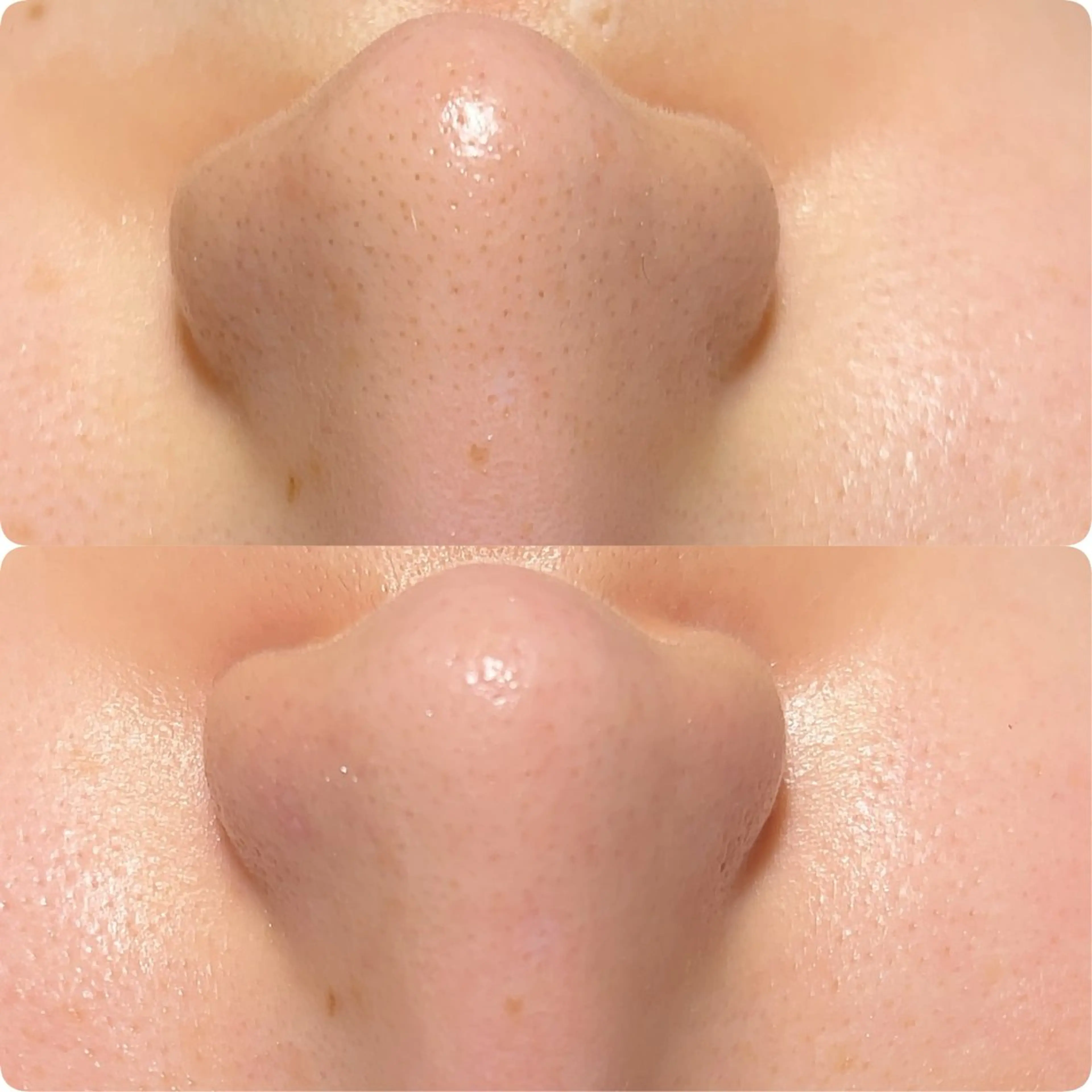 ⭐️毛穴エクストラクションのモデル募集⭐️の写真