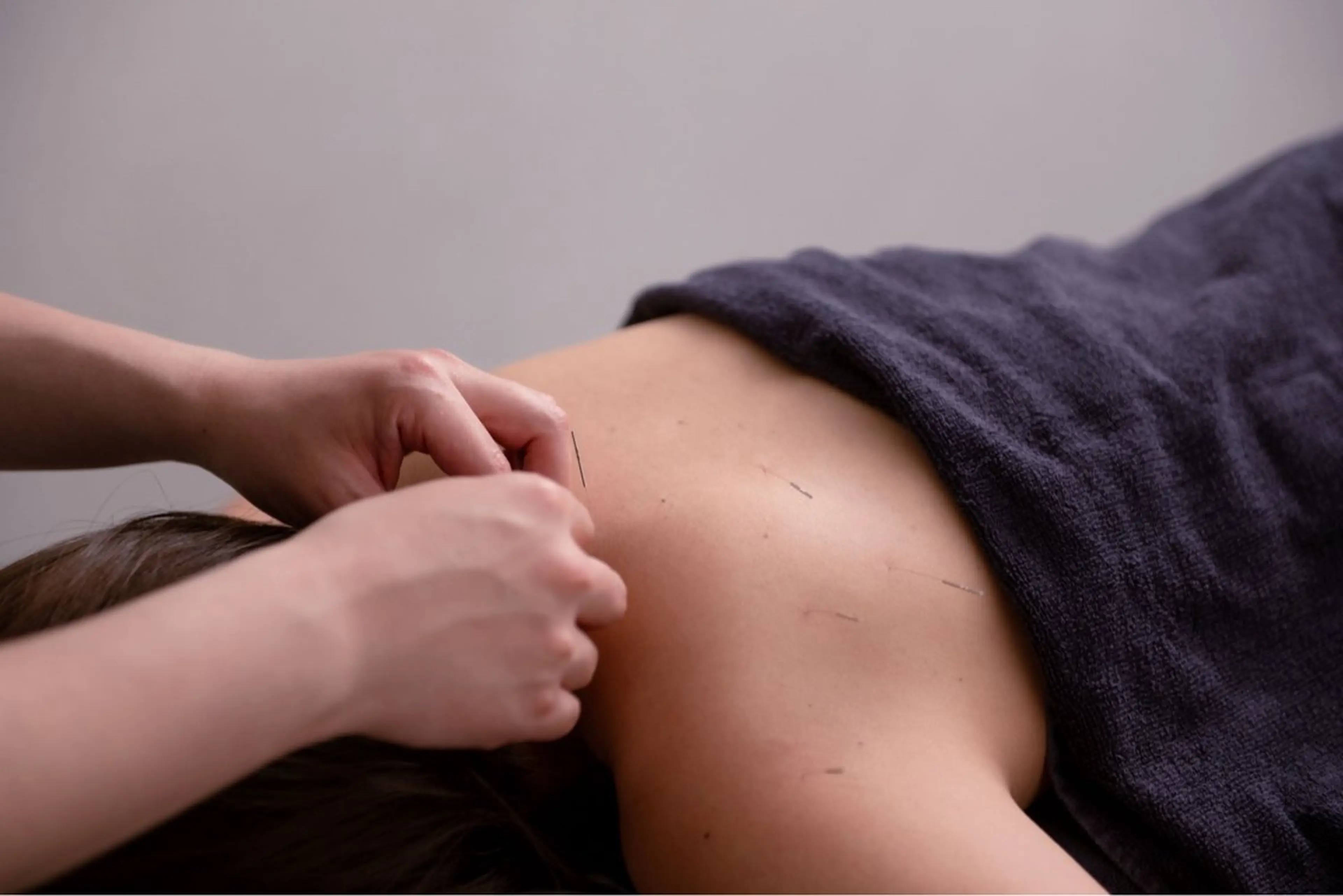 慢性的な疲労にも効果的🪡【肩こり/腰痛改善/姿勢改善/頭痛/全身対応可能】肩首こり鍼＋整体 60分の写真