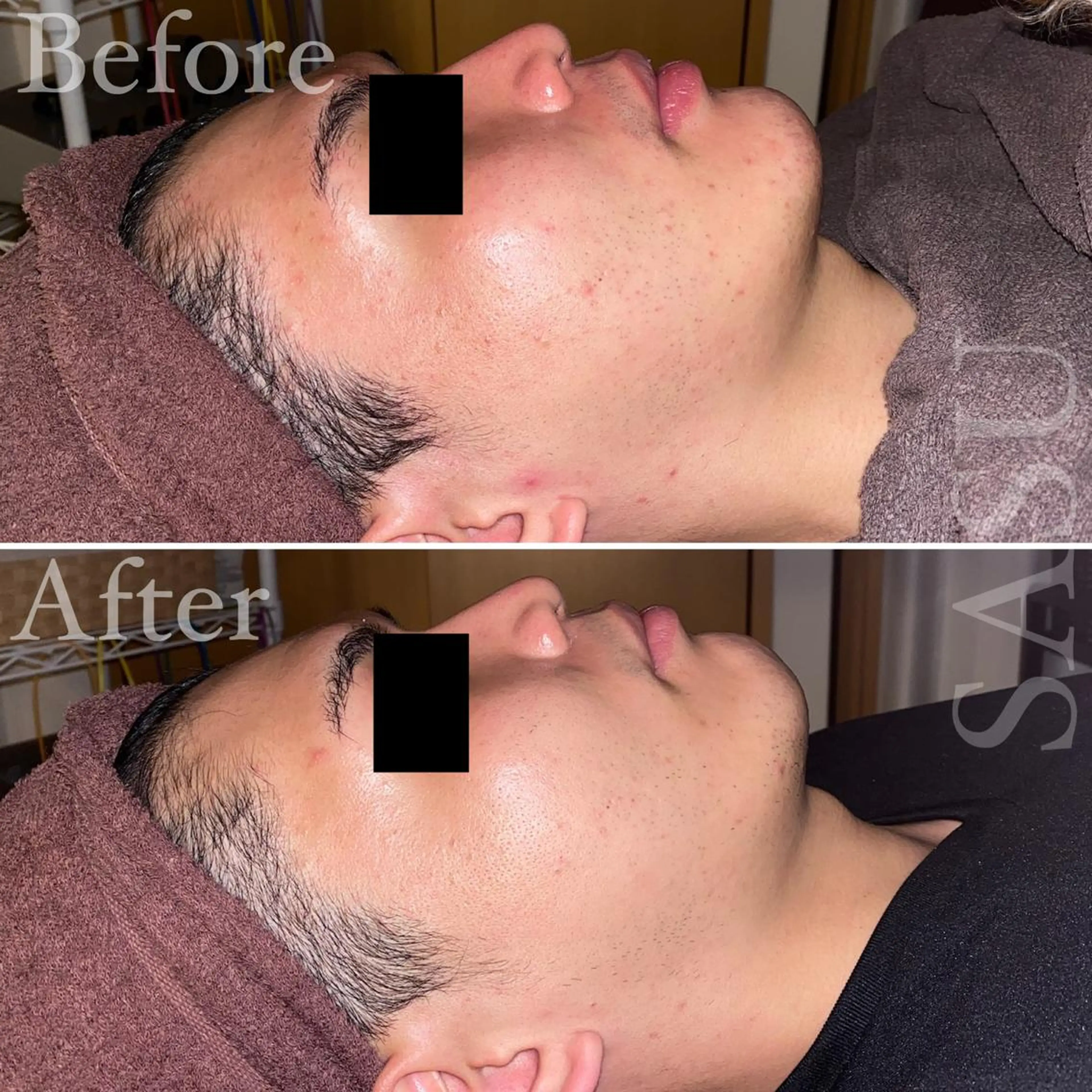 メンズ 即小顔♥️美容鍼× ハーブピーリングのその他イメージ