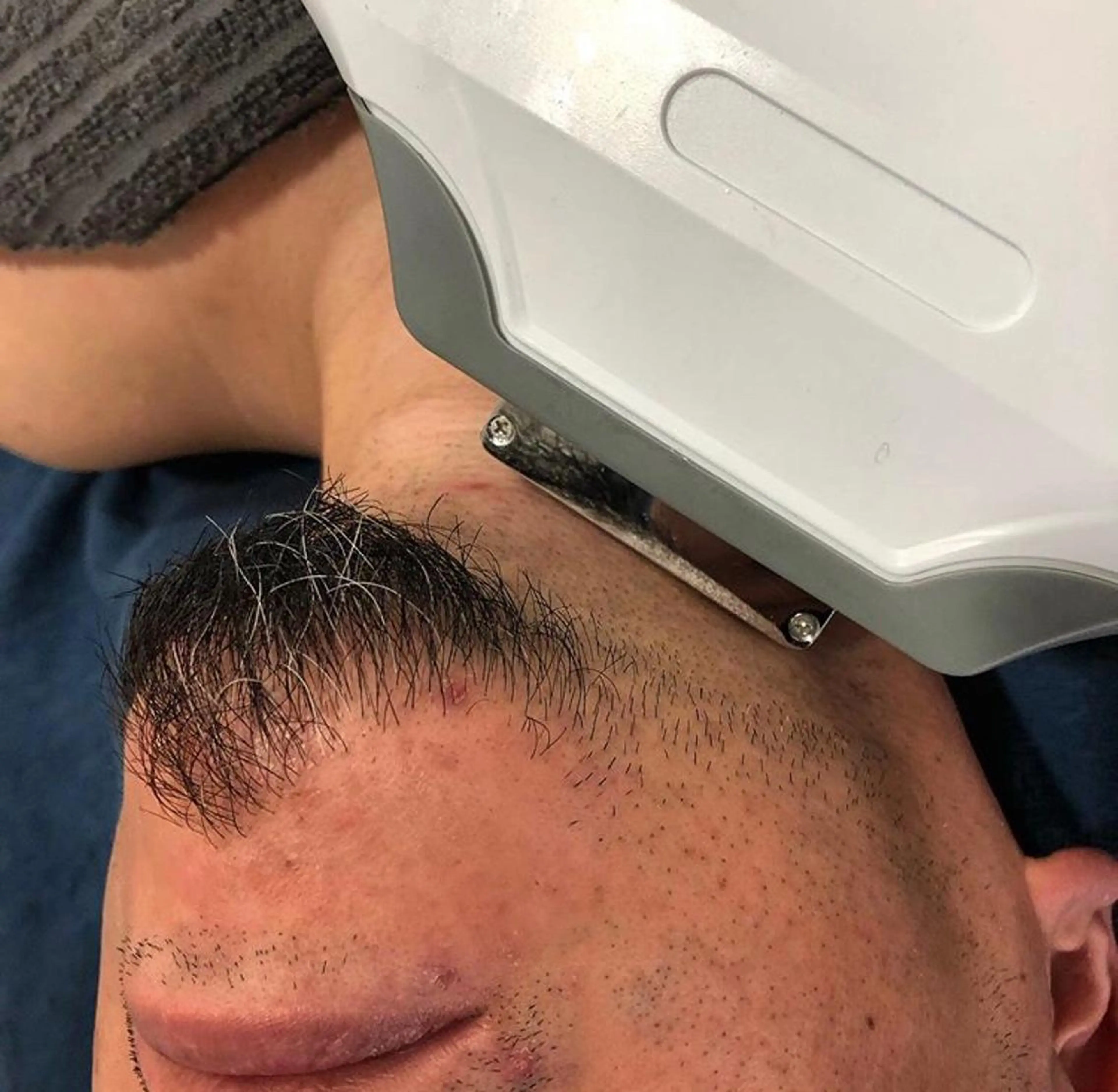 【カミソリ負けして辛い方専用】お試しヒゲ脱毛（メンズ）の写真