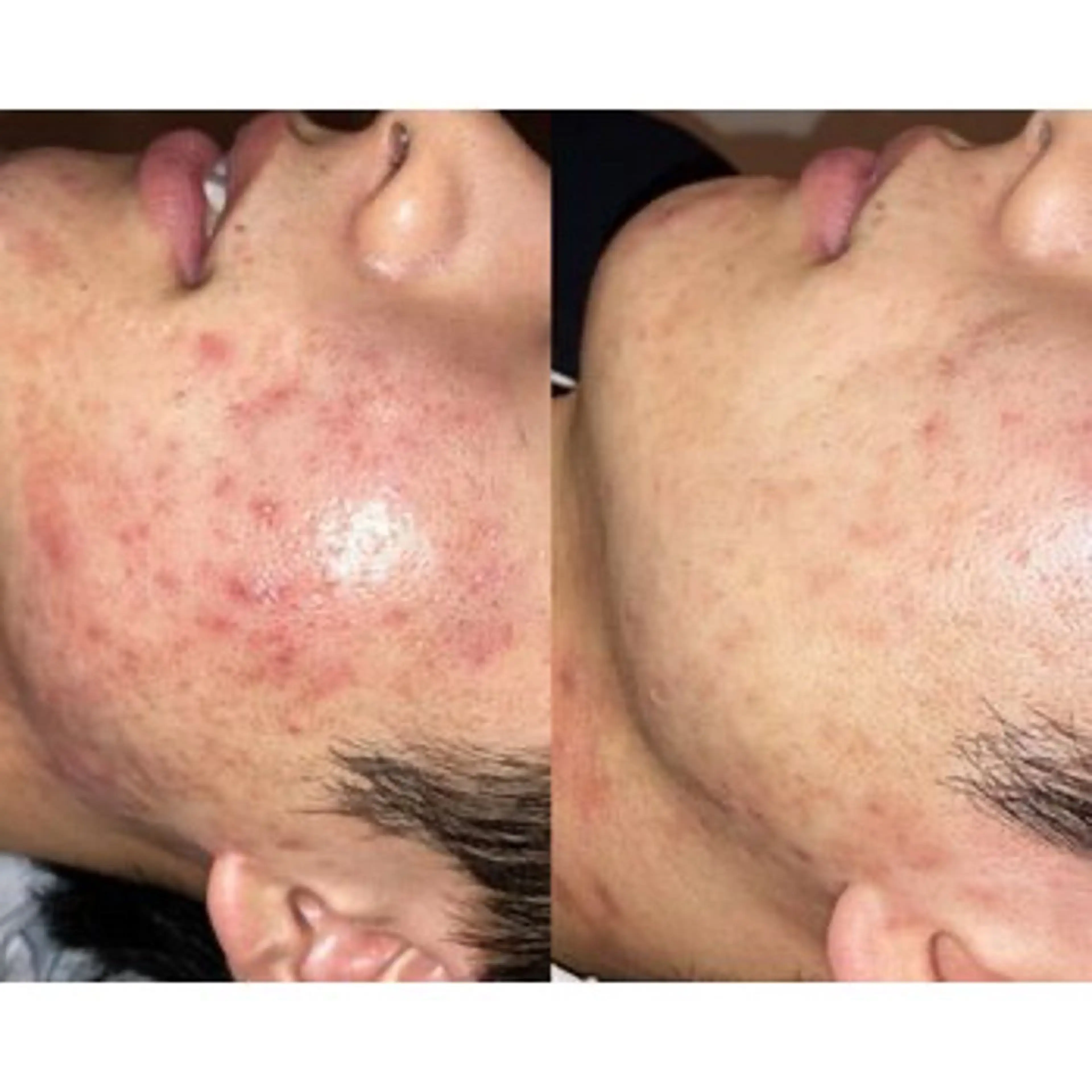 【荒れた肌を速攻鎮静】高濃度ニキビケア美容液で肌トラブルを根本から改善！の写真