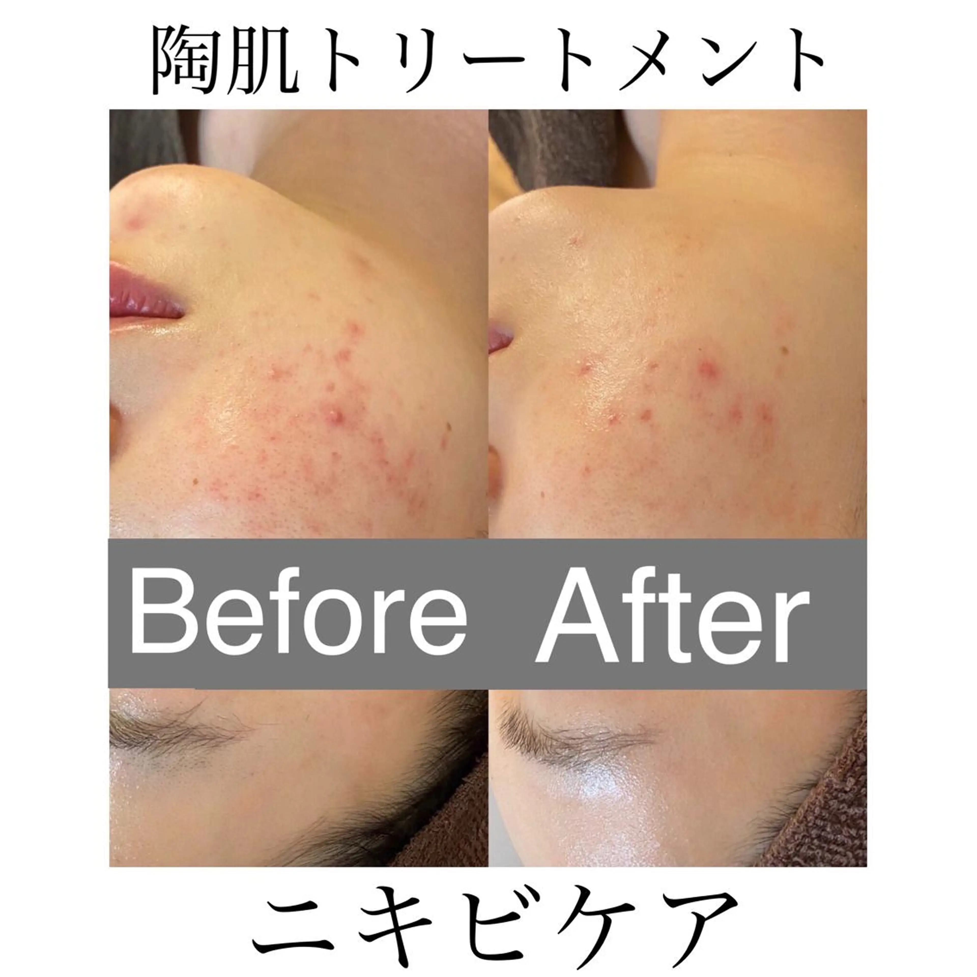 【ミニモ限定💡ハーブピーリング】　　　　　　　　　長年お悩みの方へオススメ！ニキビケアの写真