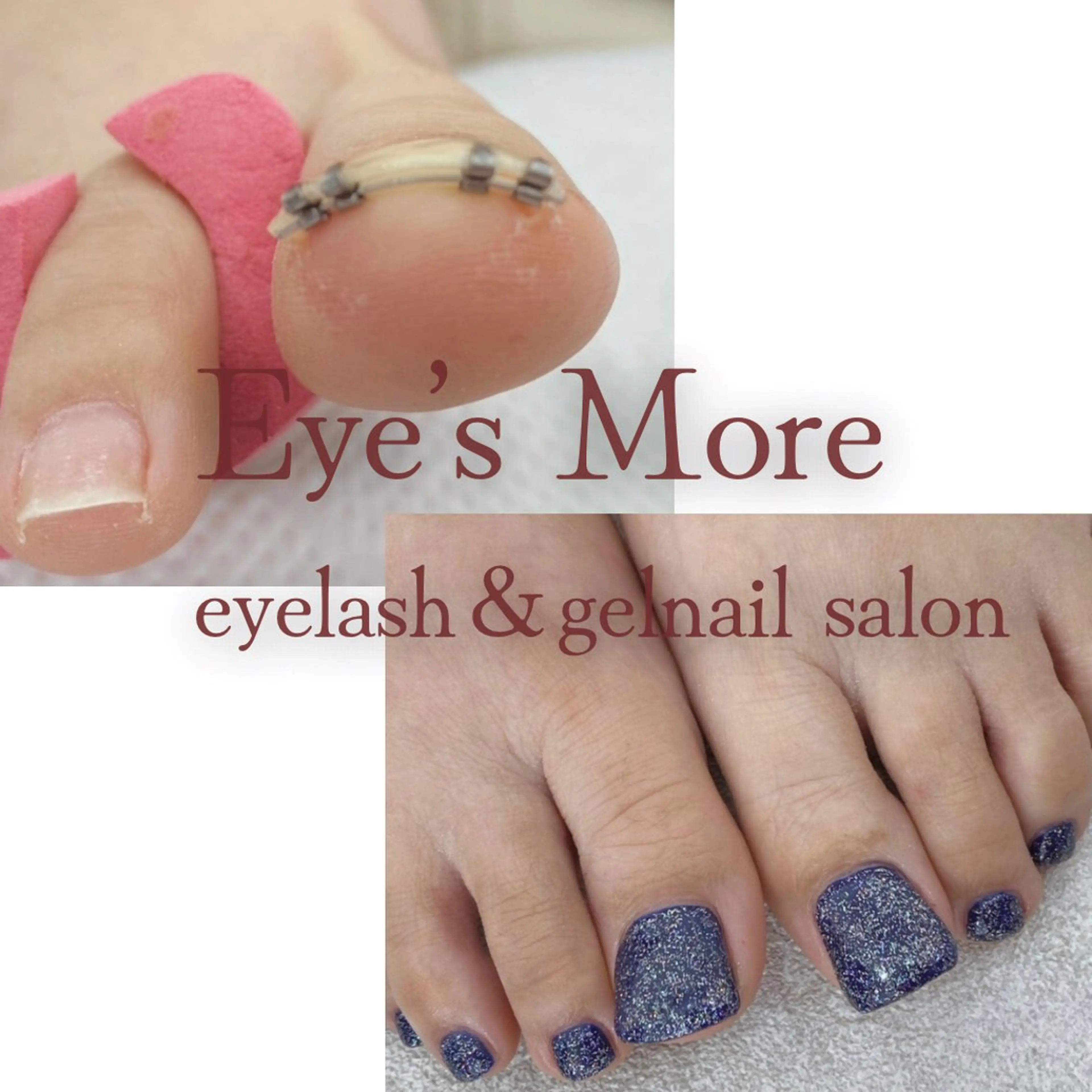 【オフ無し】フット巻き爪ケア＋ワンカラー🌈カラー2色OK🎨オフ有り・本数追加要相談⚠️予約時に患部の写真添付必須⚠️の写真