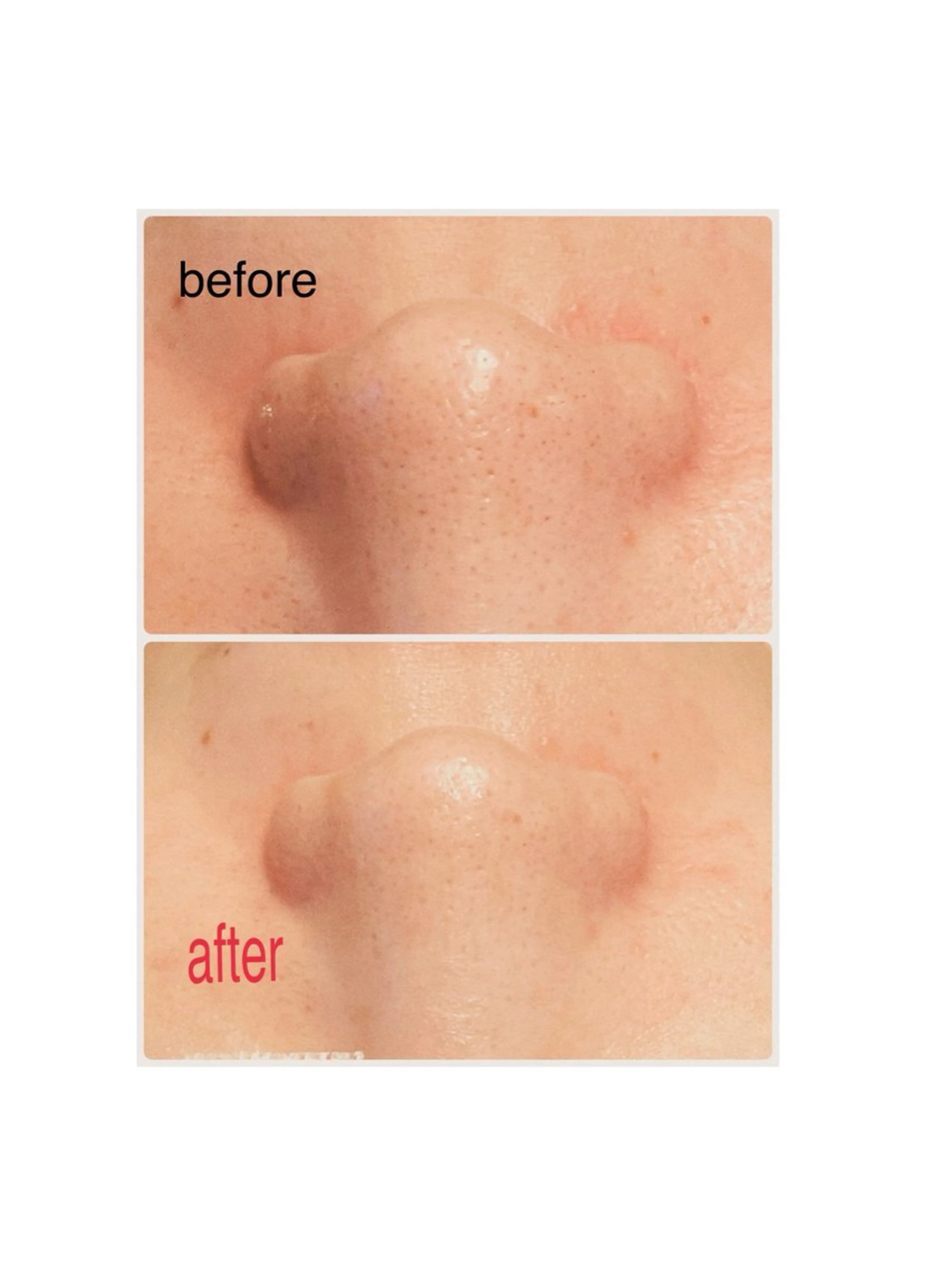 🌸毛穴洗浄(小鼻のみ)😍パック付きの写真