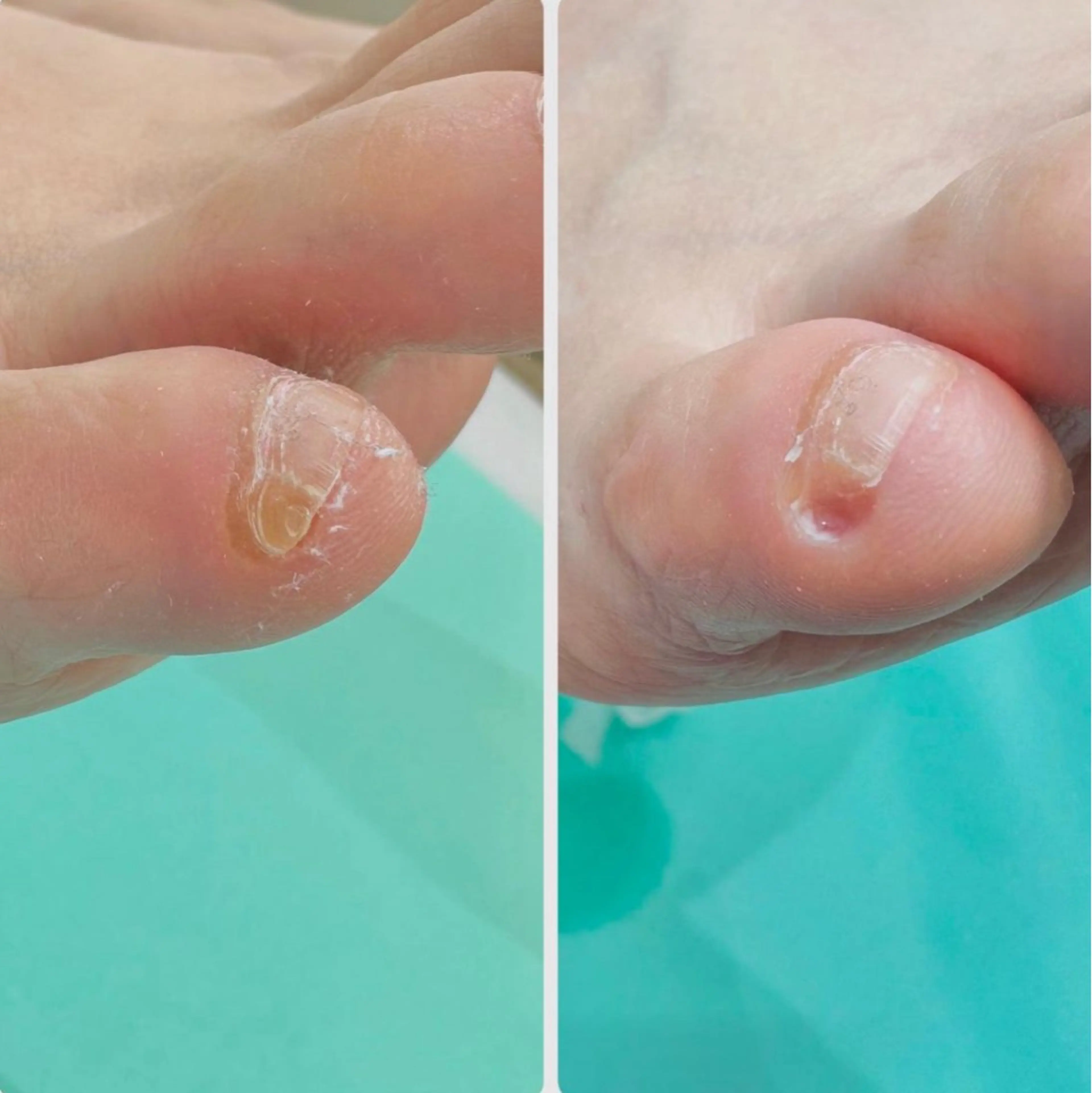 【副爪ケア】小指の爪横にある爪みたいなモノ💡キレイに除去し、痛みや違和感から開放💁♀️の写真