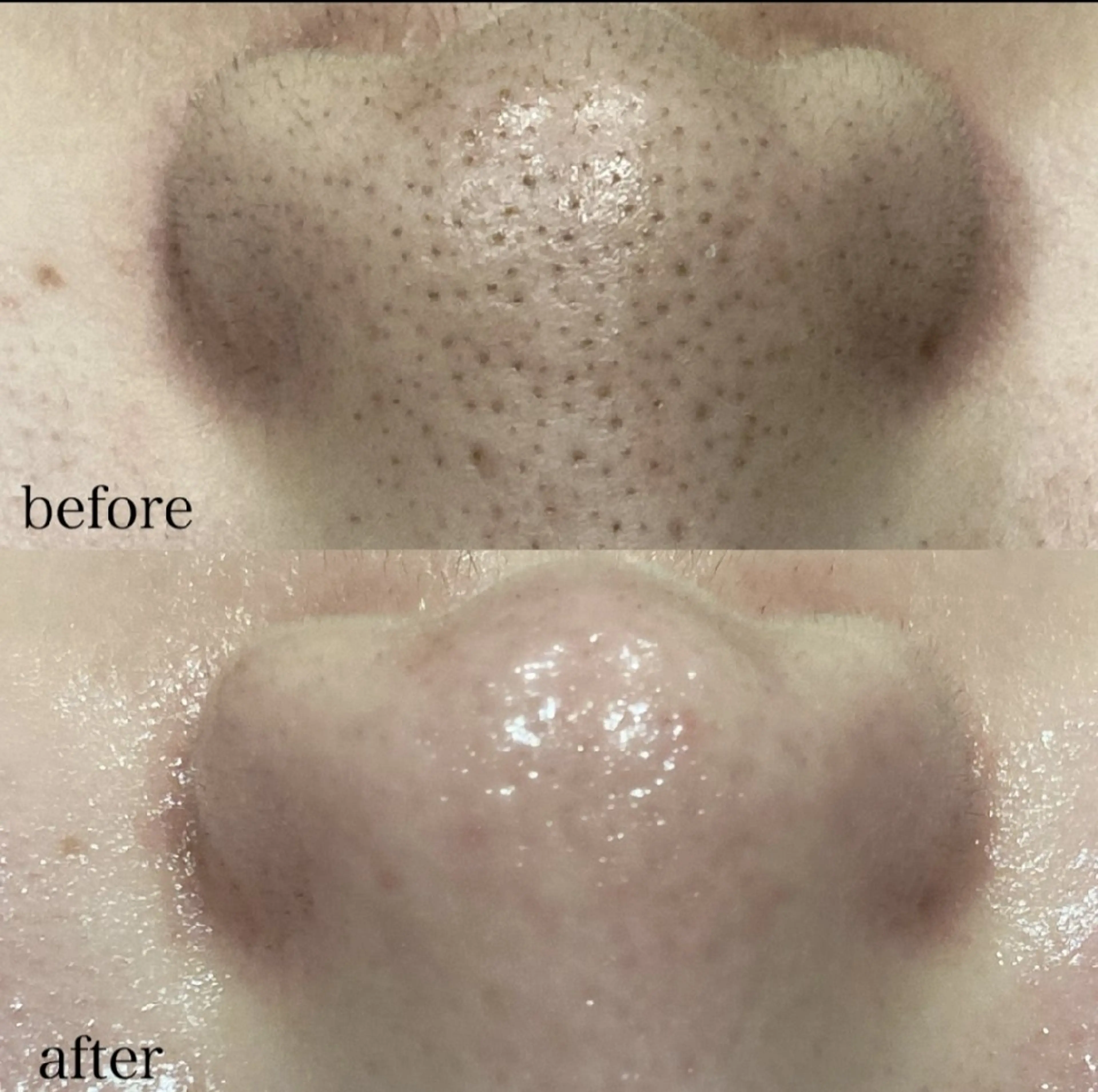 12月特別価格🌟ハイドラ毛穴洗浄+顔脱毛¥13,500→¥6,600の写真