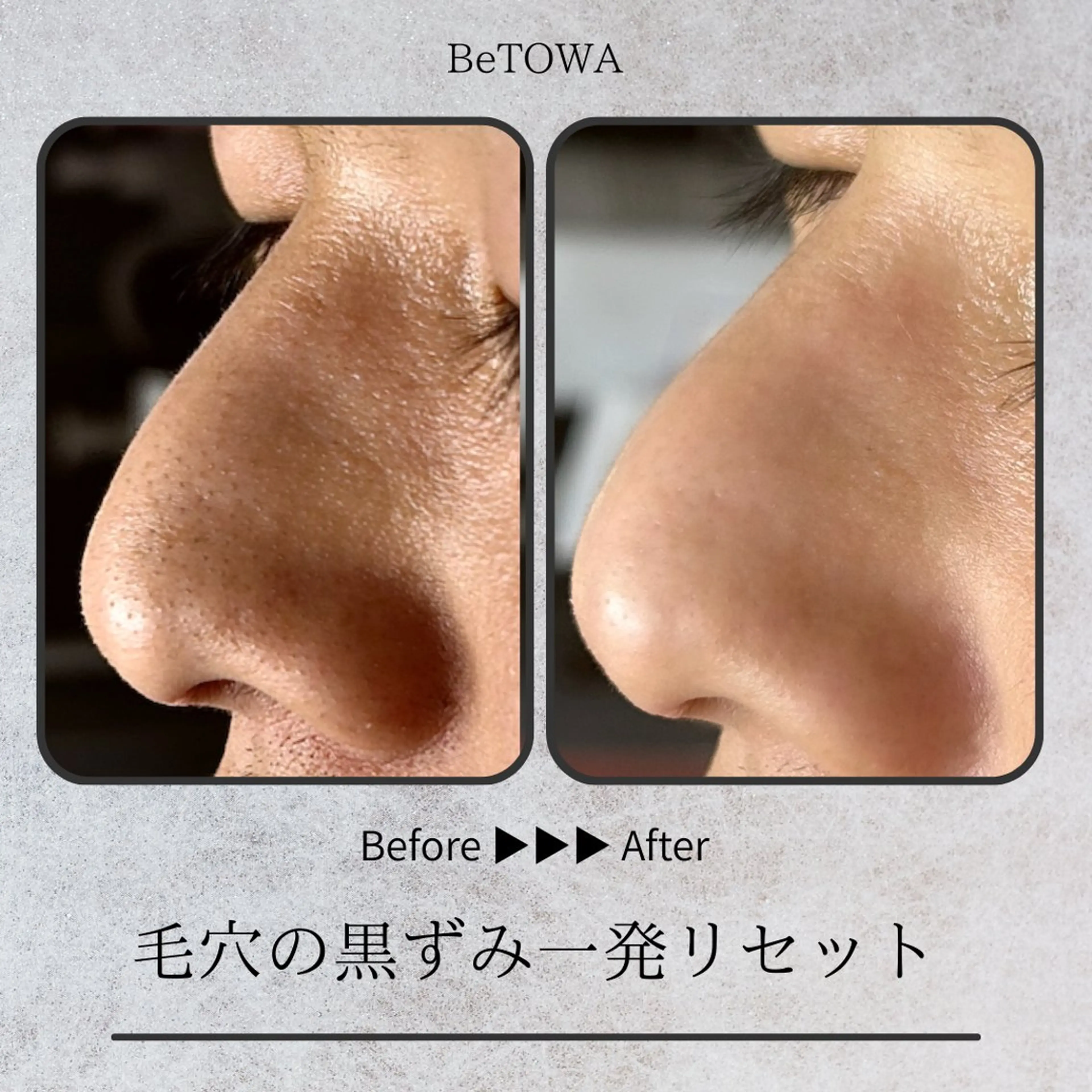 エステ BeTOWA所属・BeTOWA 毛穴洗浄／Wax脱毛のエステ・リラクイメージ