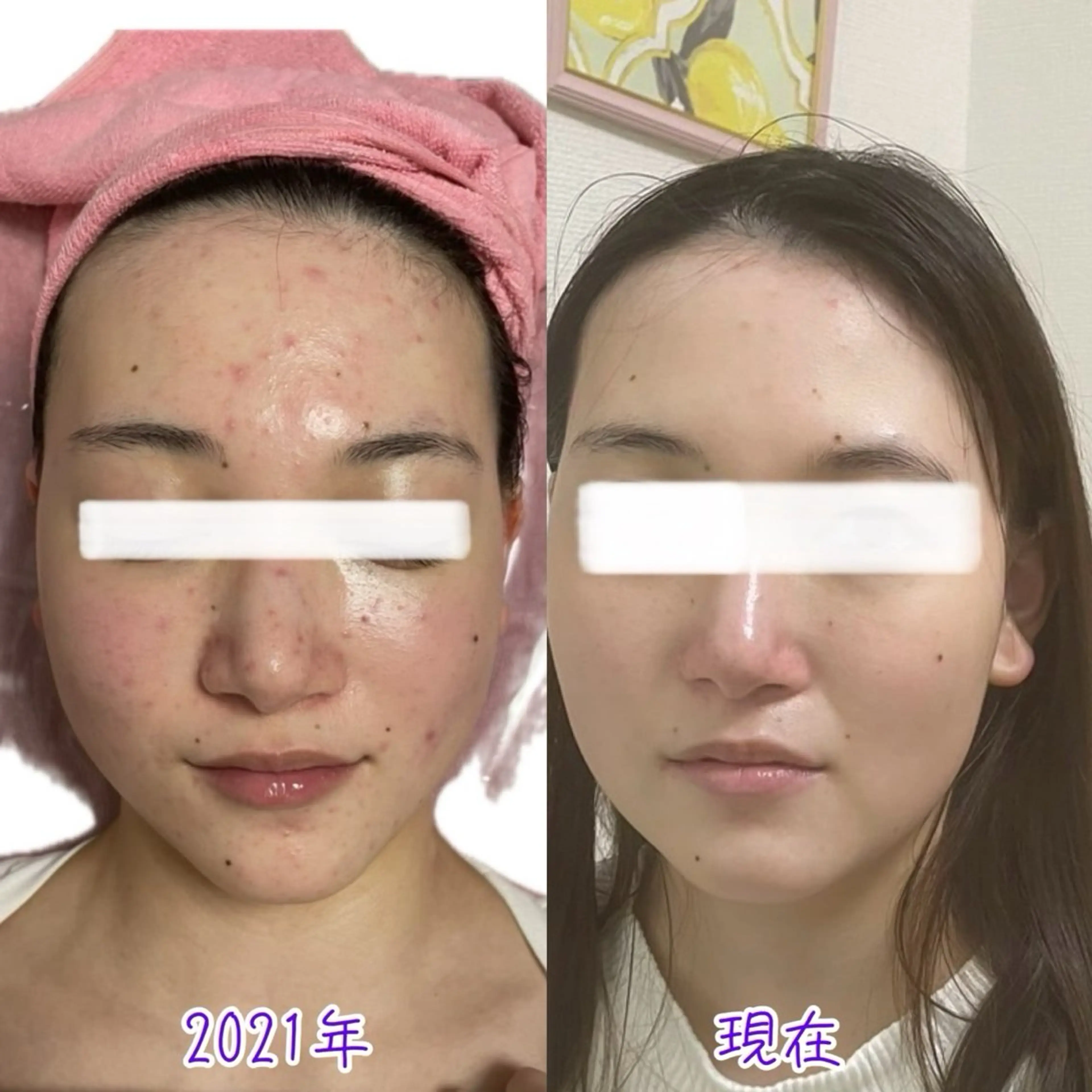 ★顔全体毛穴洗浄とポレーションモードで美容液導入「イオン導入の16倍」ピールオフパック付☀️透明感やもちもち肌希望の方の写真