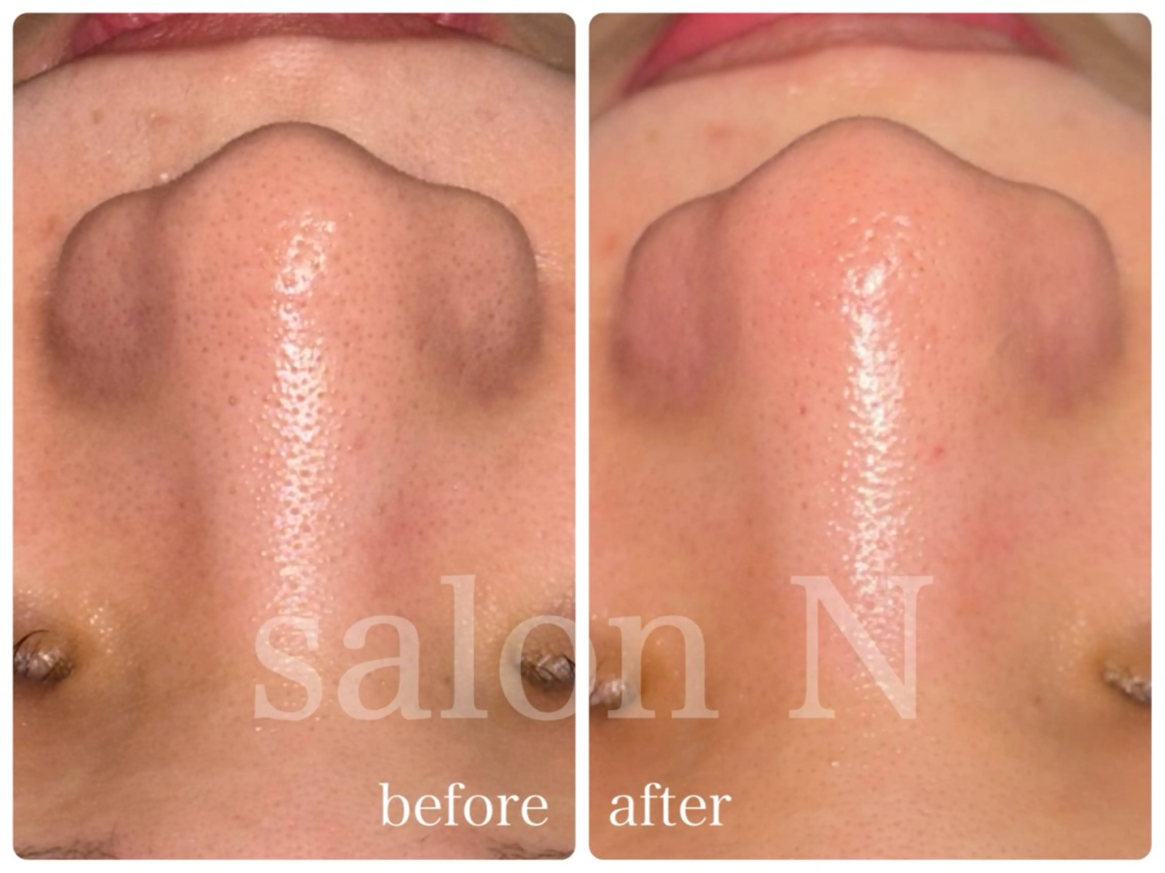 毛穴洗浄🫧¥6,600→¥3,300✨スキンケアでは取り切れない汚れをスッキリ綺麗に♪(鼻のみ)の写真