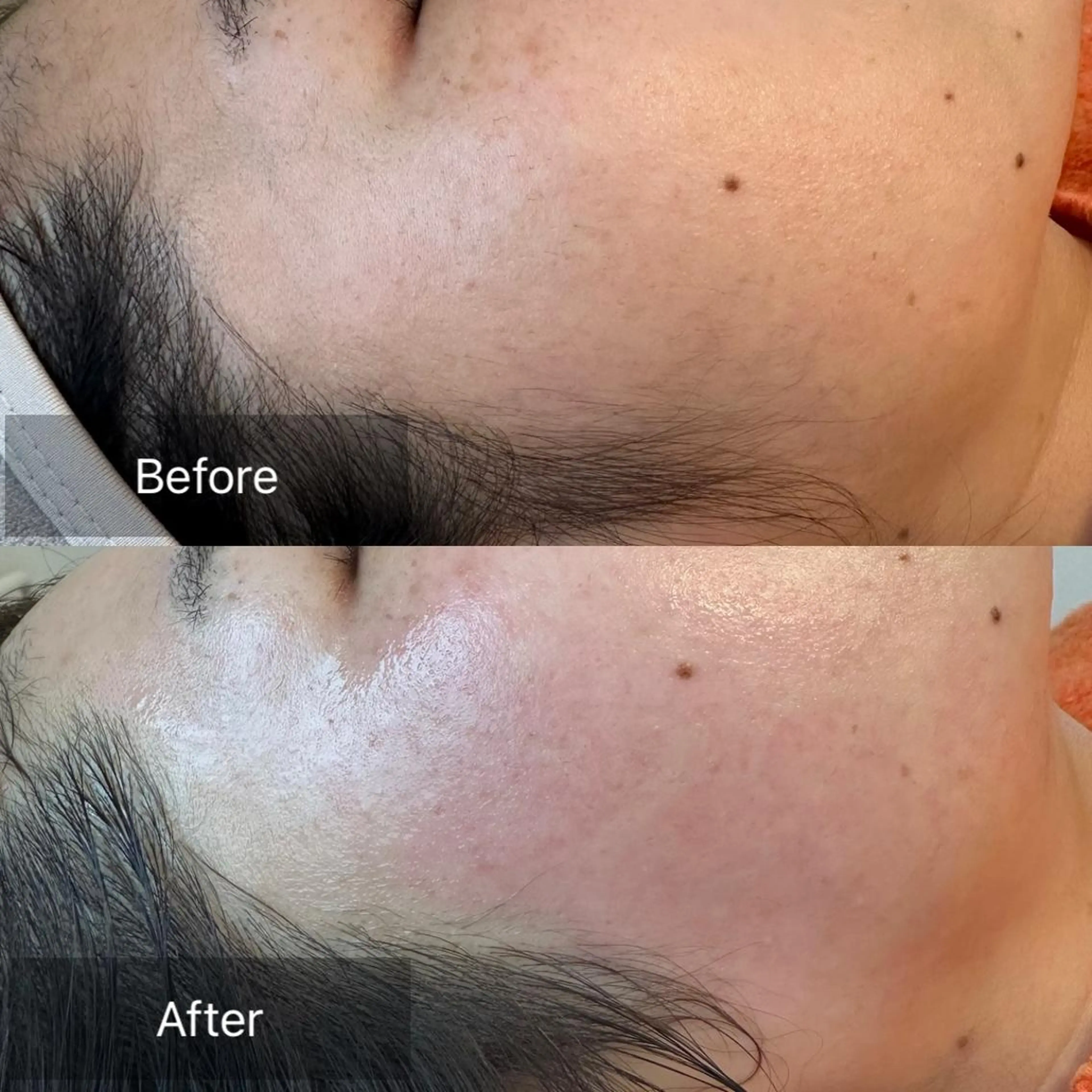 【冬の潤い・透明感アップコース】フェイスワックス＋高保湿炭酸ガスパックの写真