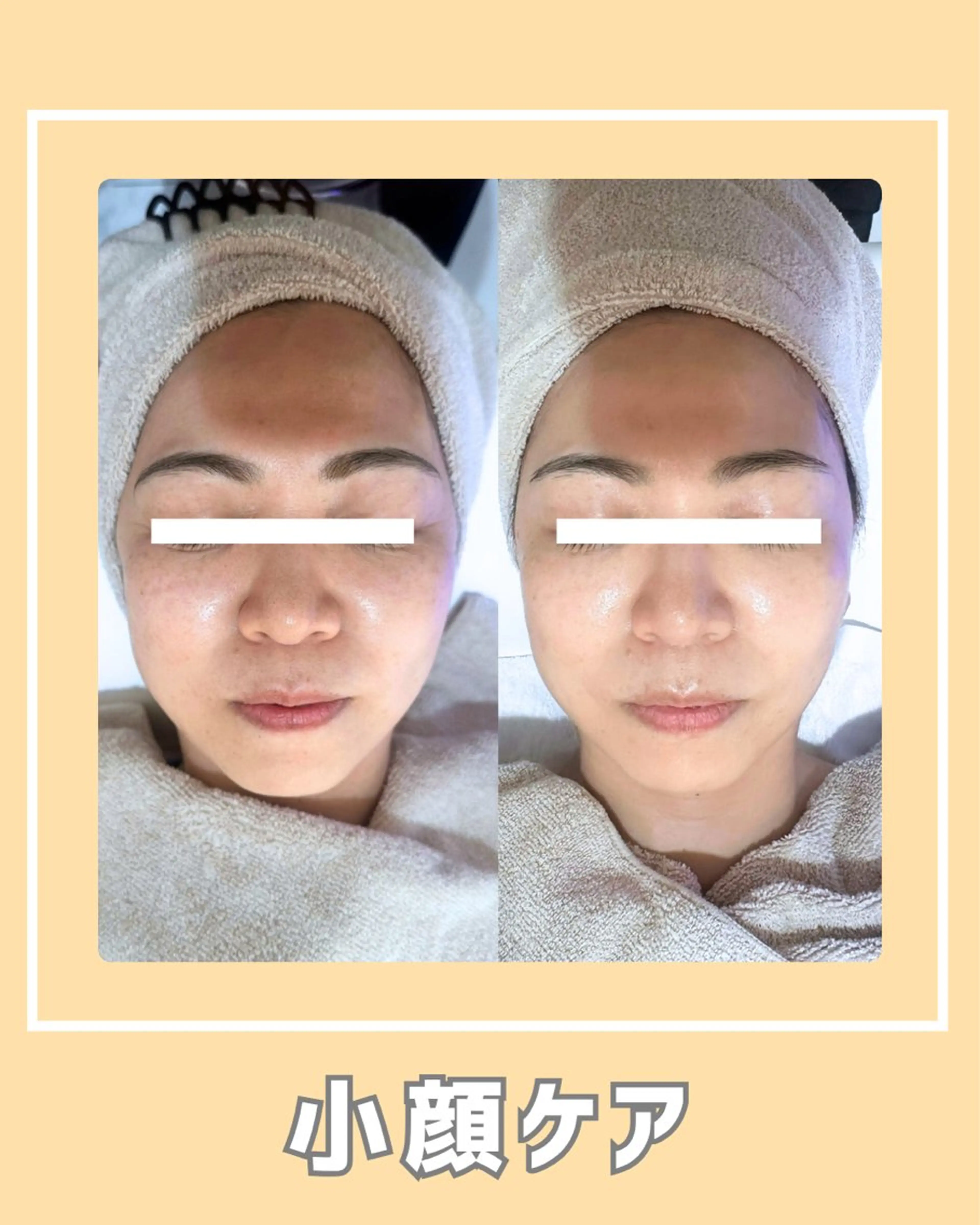 その他 |ピーリング・毛穴| soina神楽坂のエステ・リラクイメージ