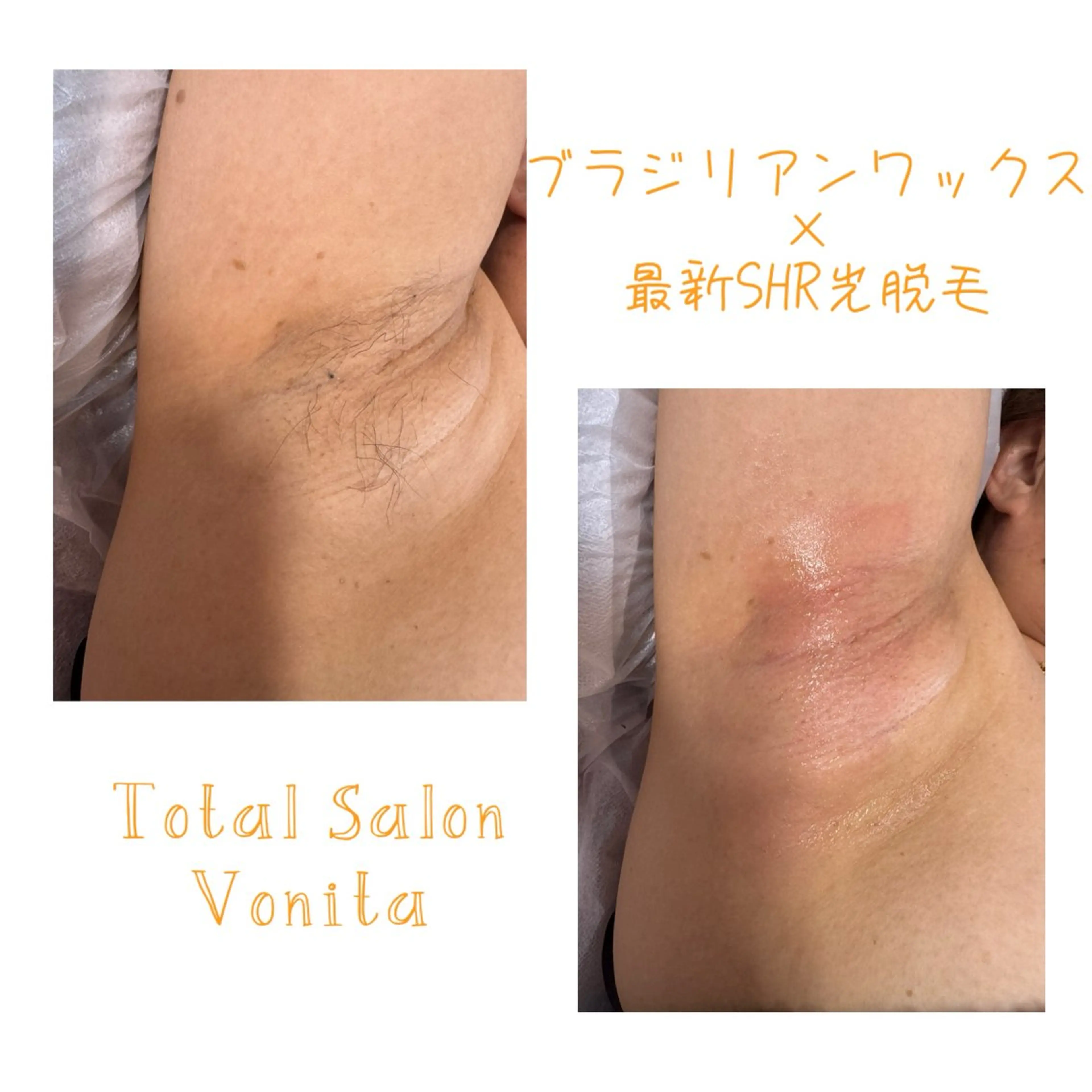 夏に向けて 両脇 ダブル脱毛🤍ブラジリアンワックス＋最新光脱毛🧡の写真