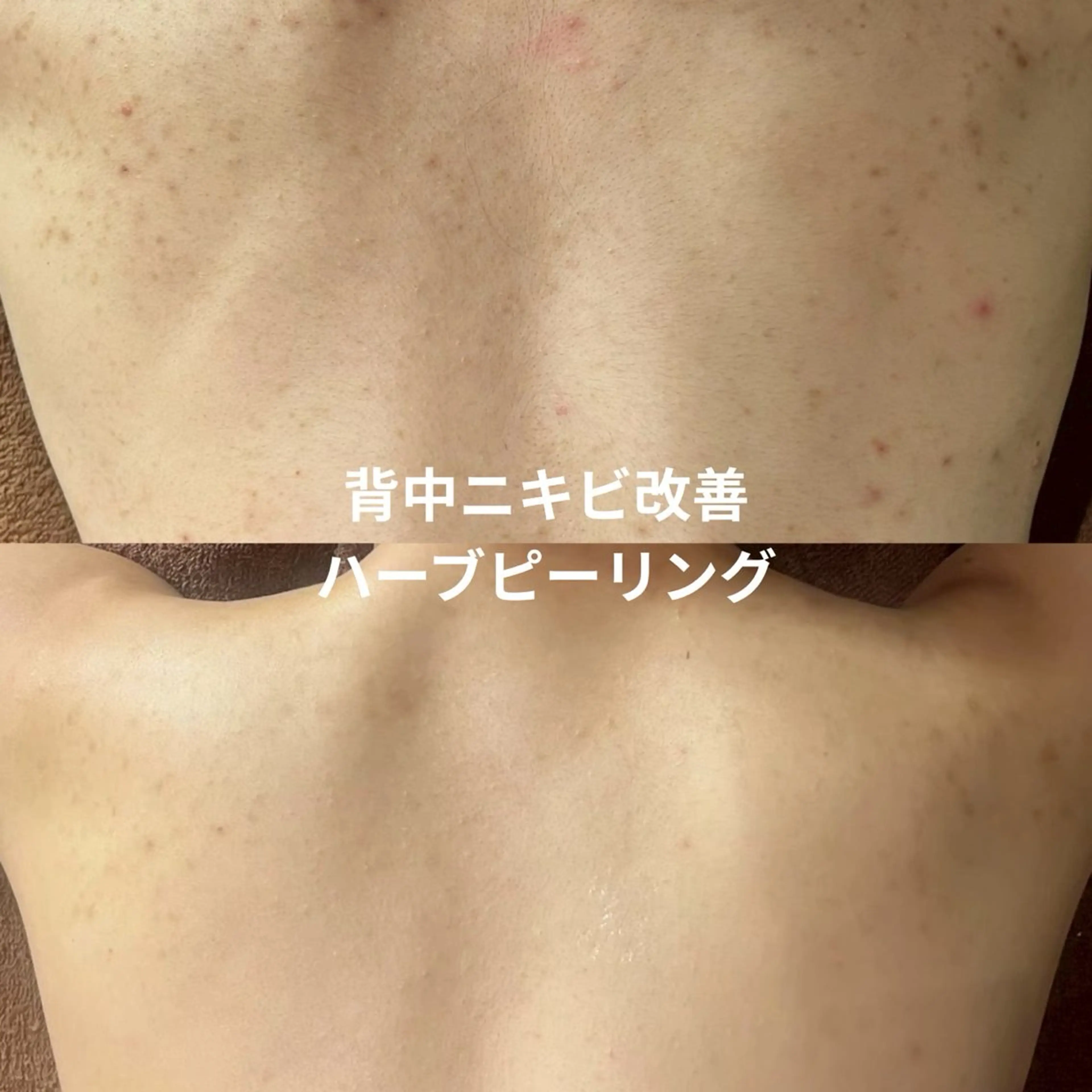 背中ハーブピーリング|ニキビ・赤み・ざらつき集中ケアの写真