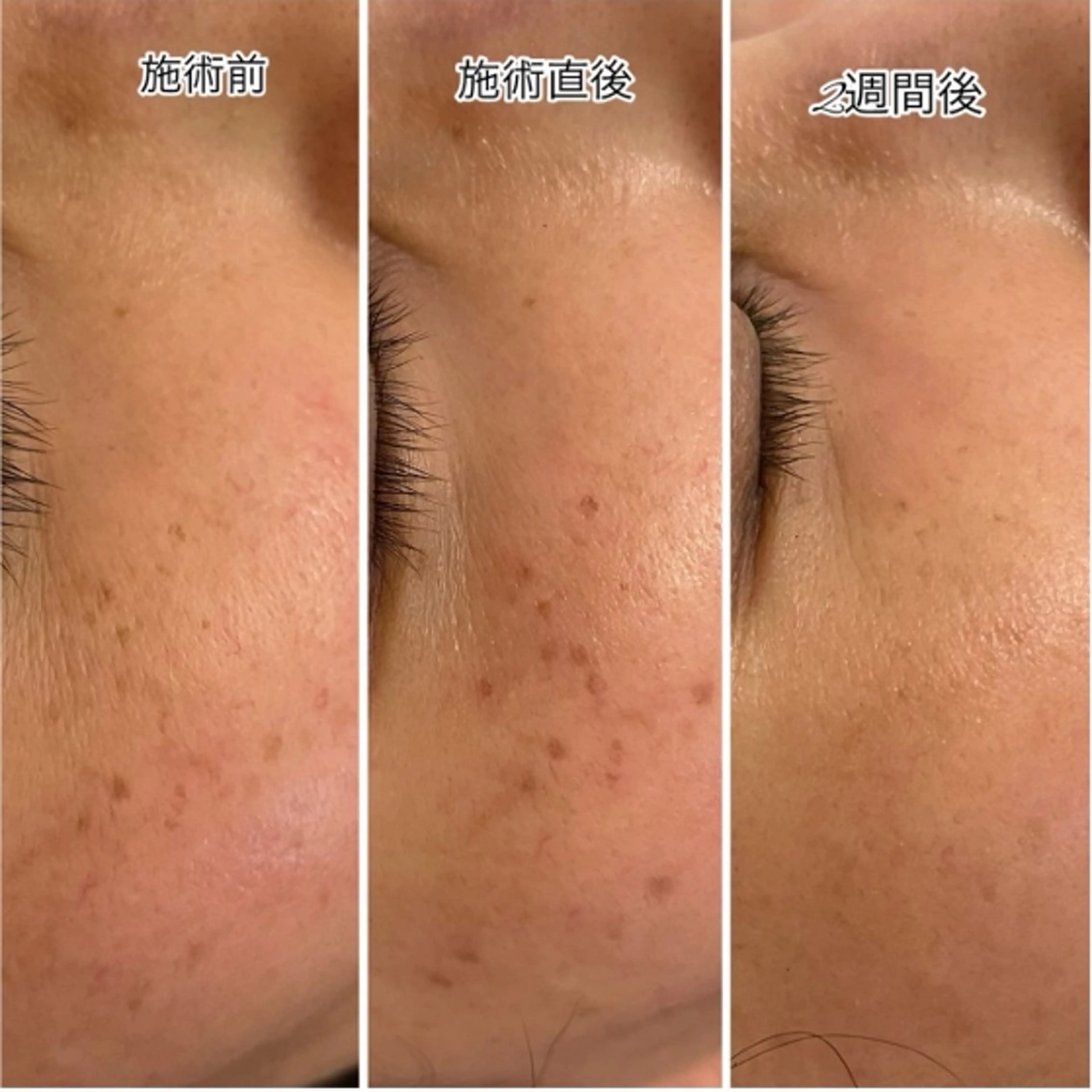 【再来】【10月末まで限定🌷】フェイシャルシミケアマシン15分あて放題(＋ヘッドマッサージ✨)の写真