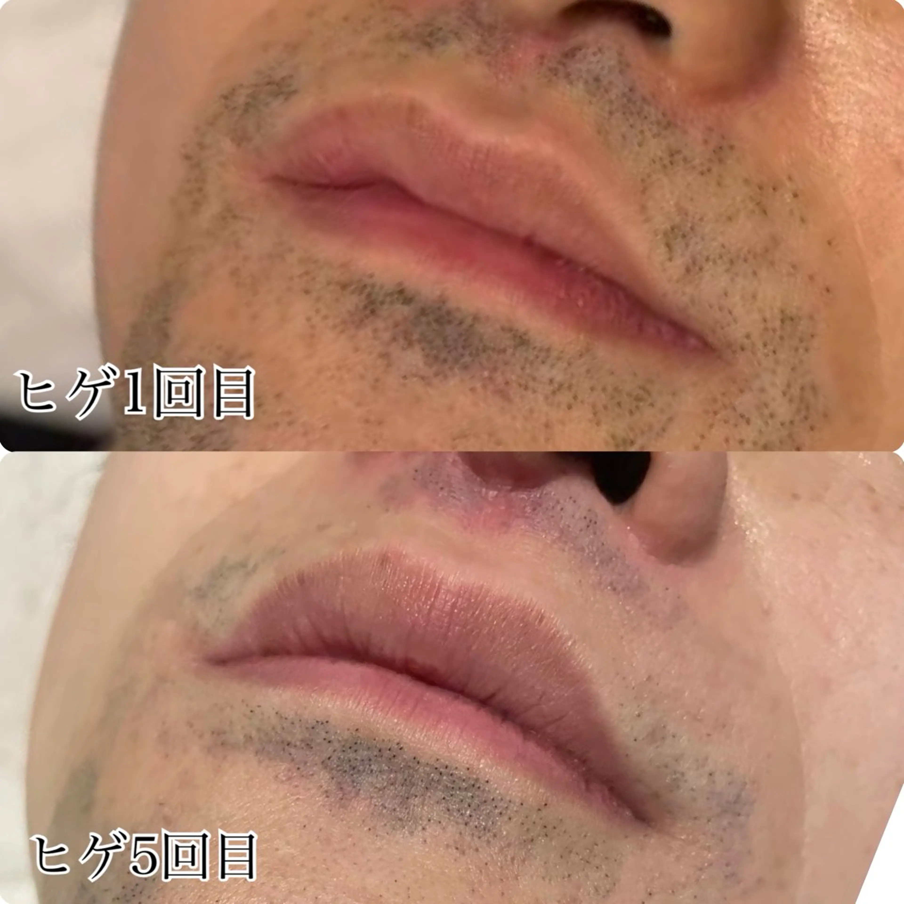 men'sヒゲ脱毛1回の写真