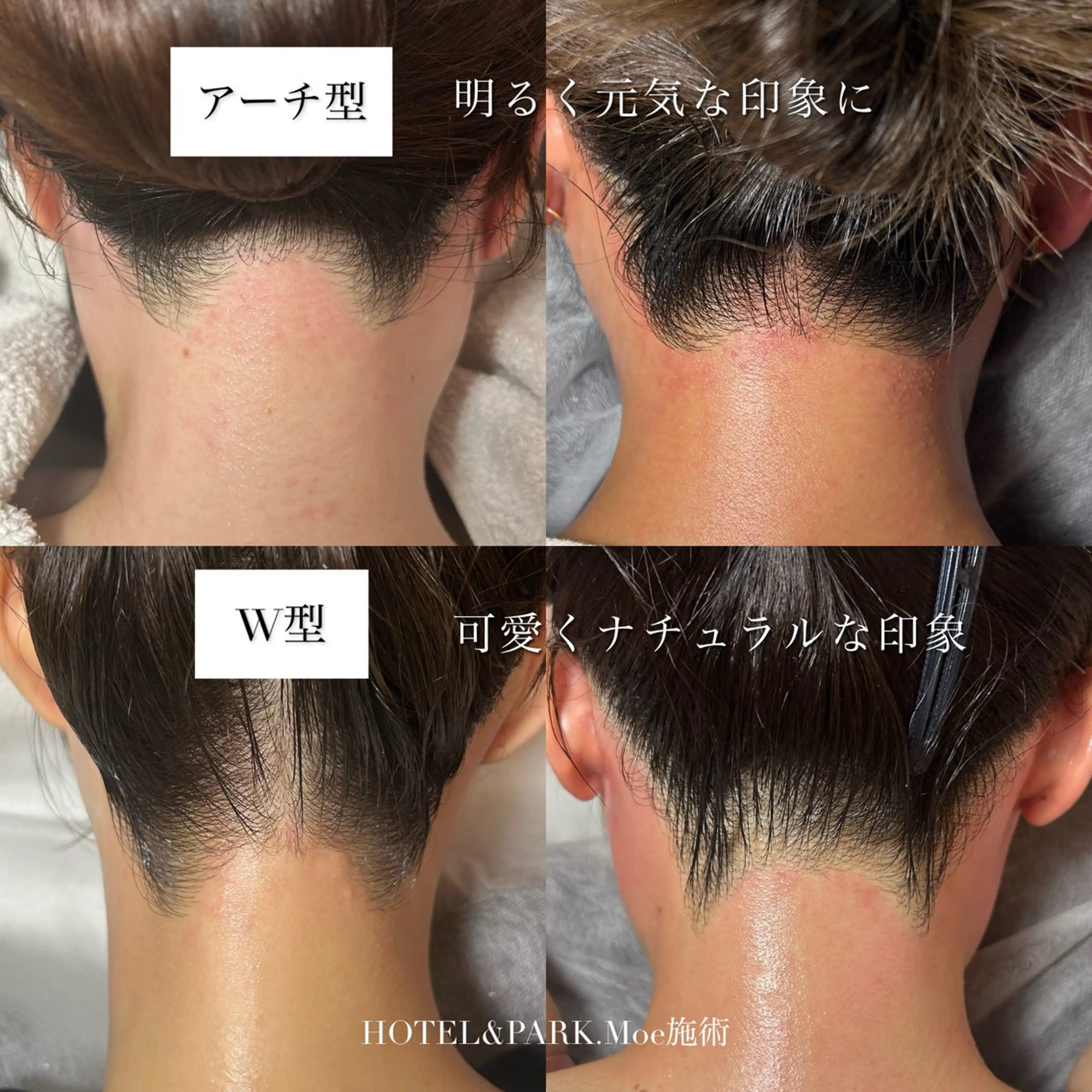 脱毛 HOTEL&PARK .Moeワックス脱毛のエステ・リラクイメージ