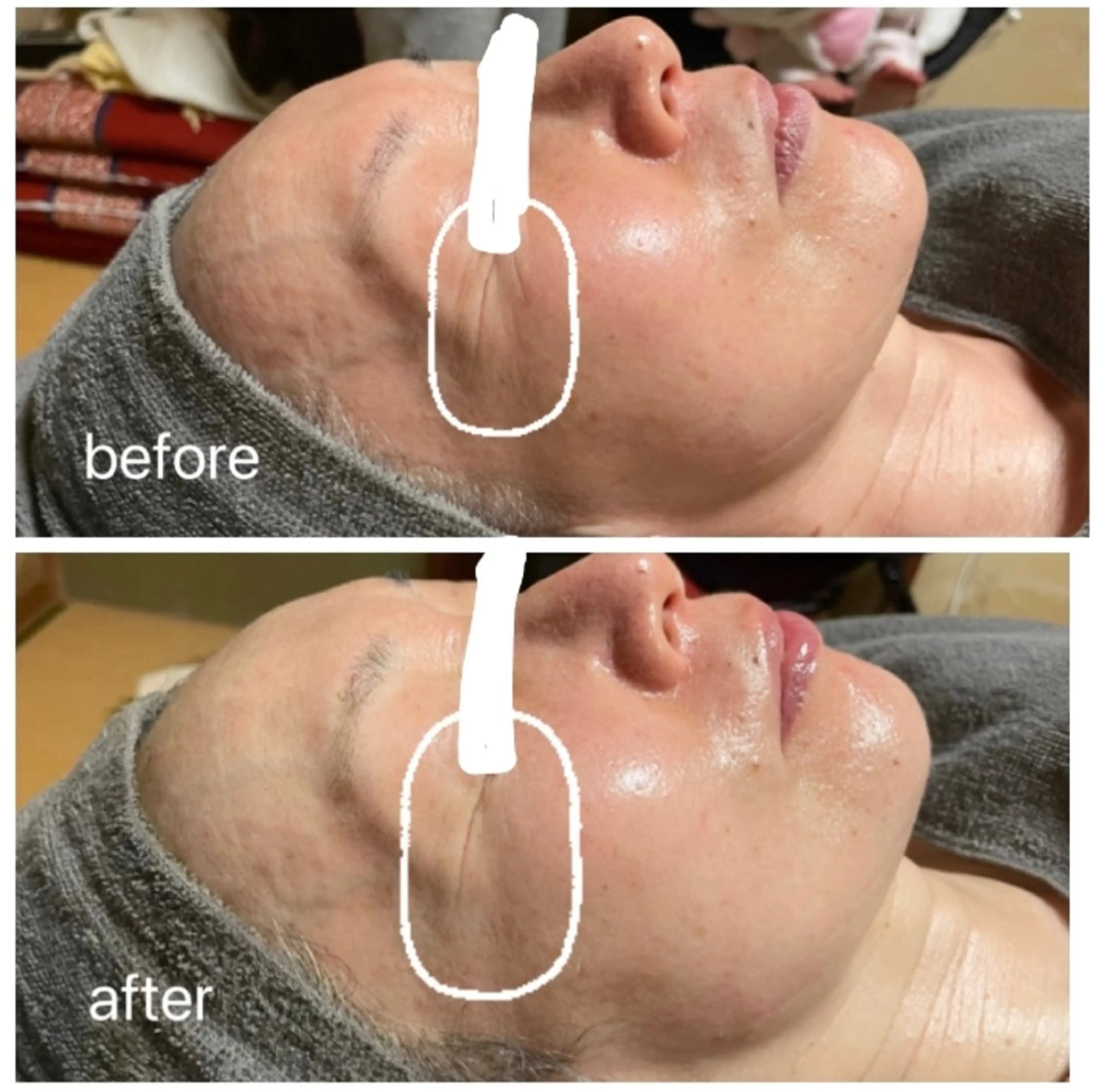 【深いシワさよなら細胞美容で若化が叶う🧬】陶肌トリートメント＋オプション🎁スキンケア半顔体験付きの写真