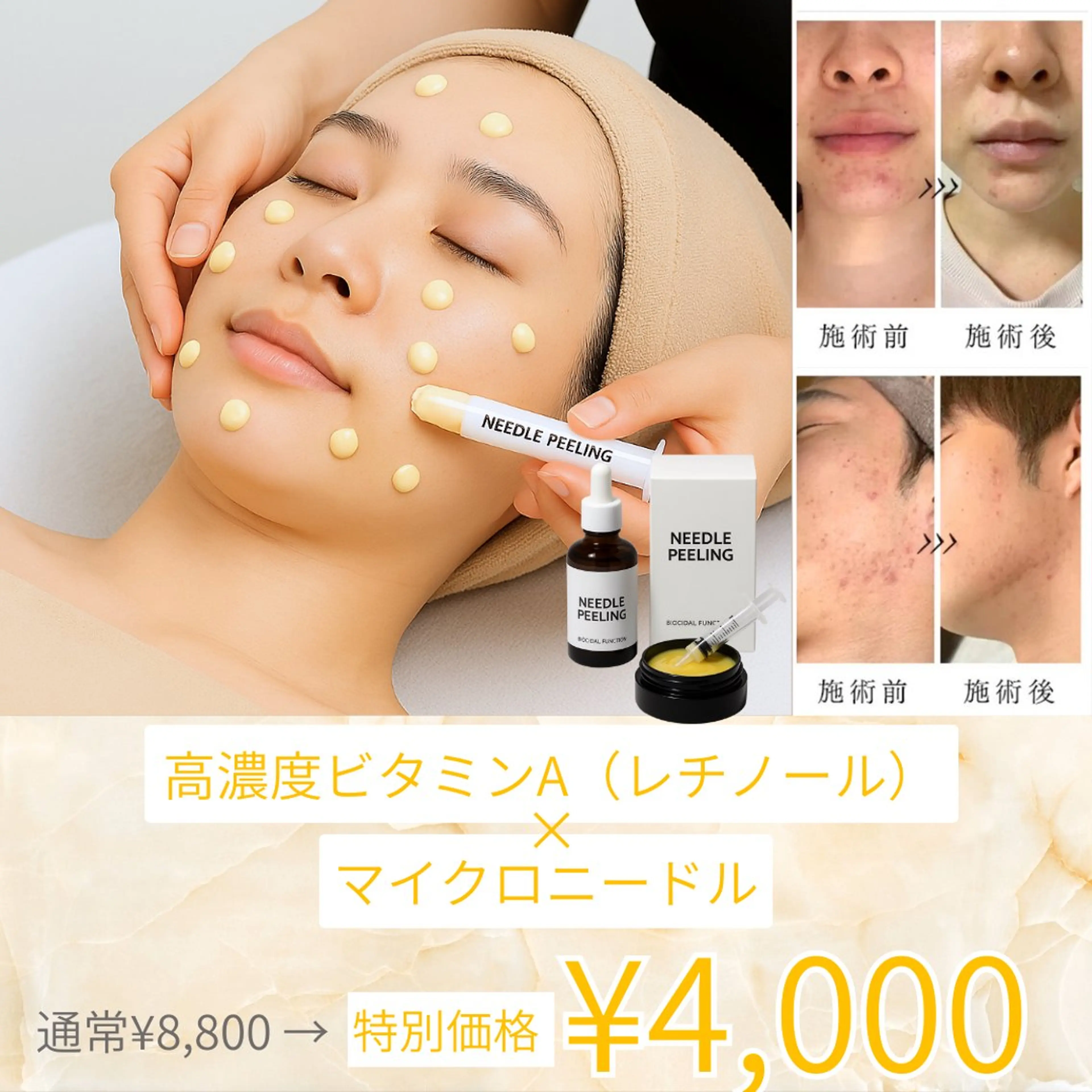 肌質改善ピーリング ✧BestBelleのエステ・リラクイメージ