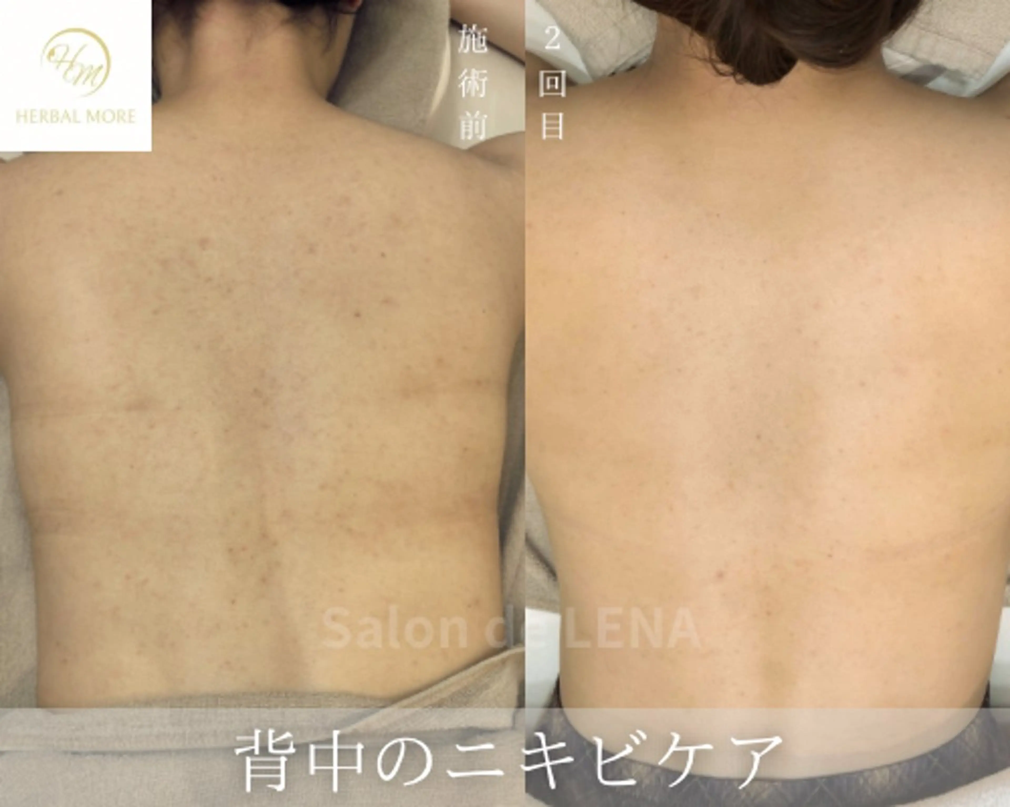 エステ サロンドレナ名駅店所属・ハーブピーリング専門 サロンドレナ平岡のエステ・リラクイメージ