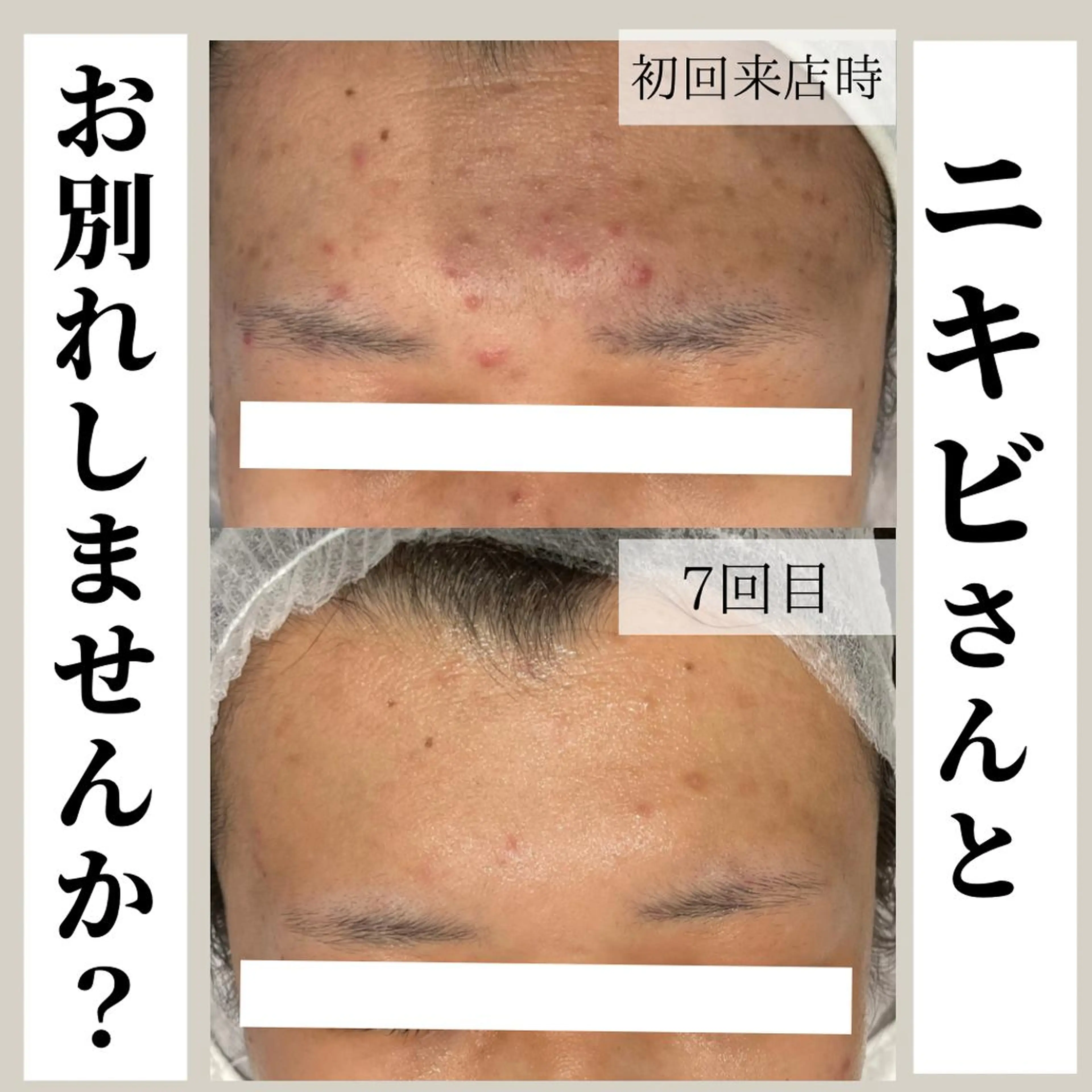 《しつこいニキビをケア》スチームフェイシャルマッサージ。鎮静パック付き。の写真