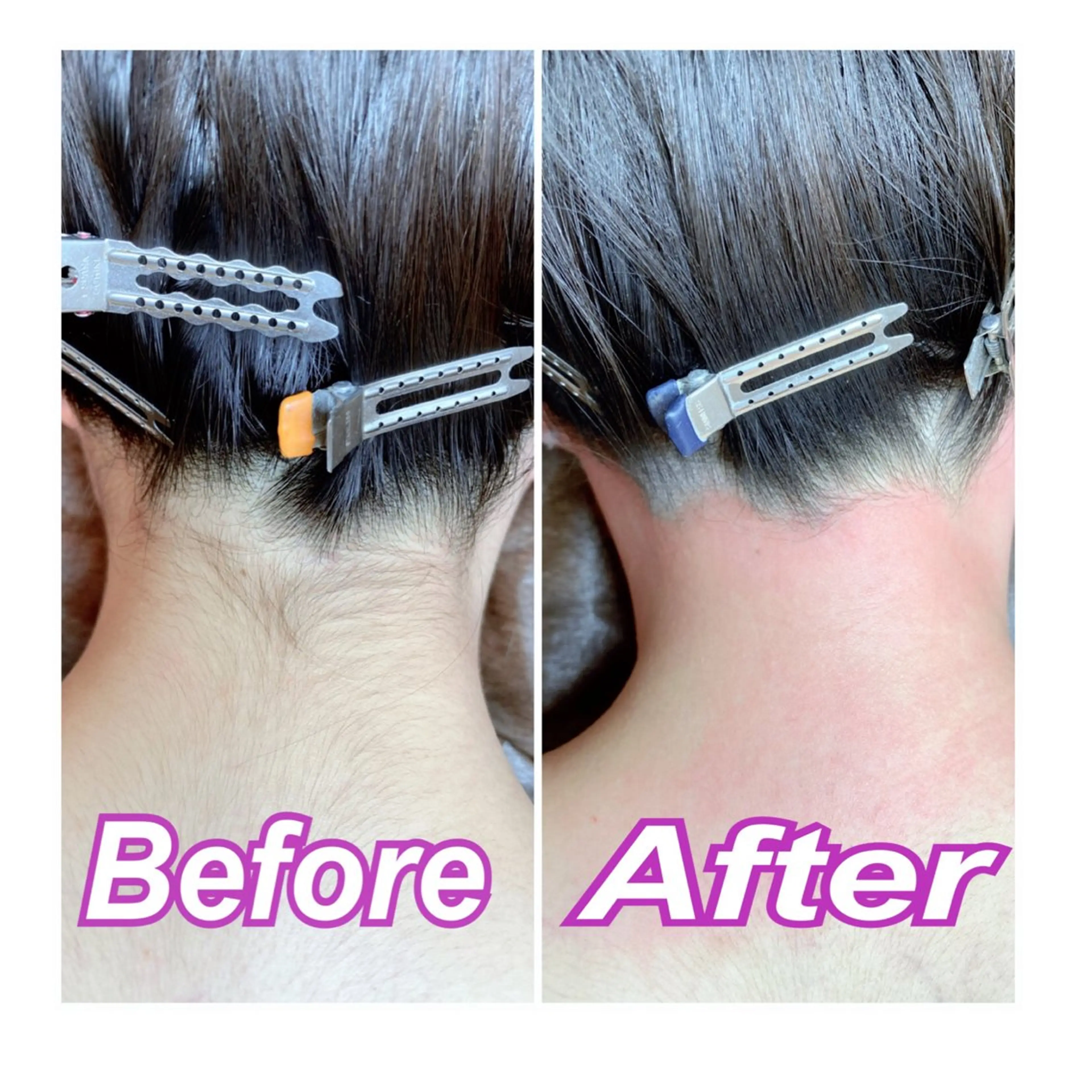 ✨成人式、卒業式を迎える方限定✨うなじ脱毛‼︎‼︎一生に一度の晴れ姿だからこそ周りと差がつけられるうなじ美人🧡✨の写真