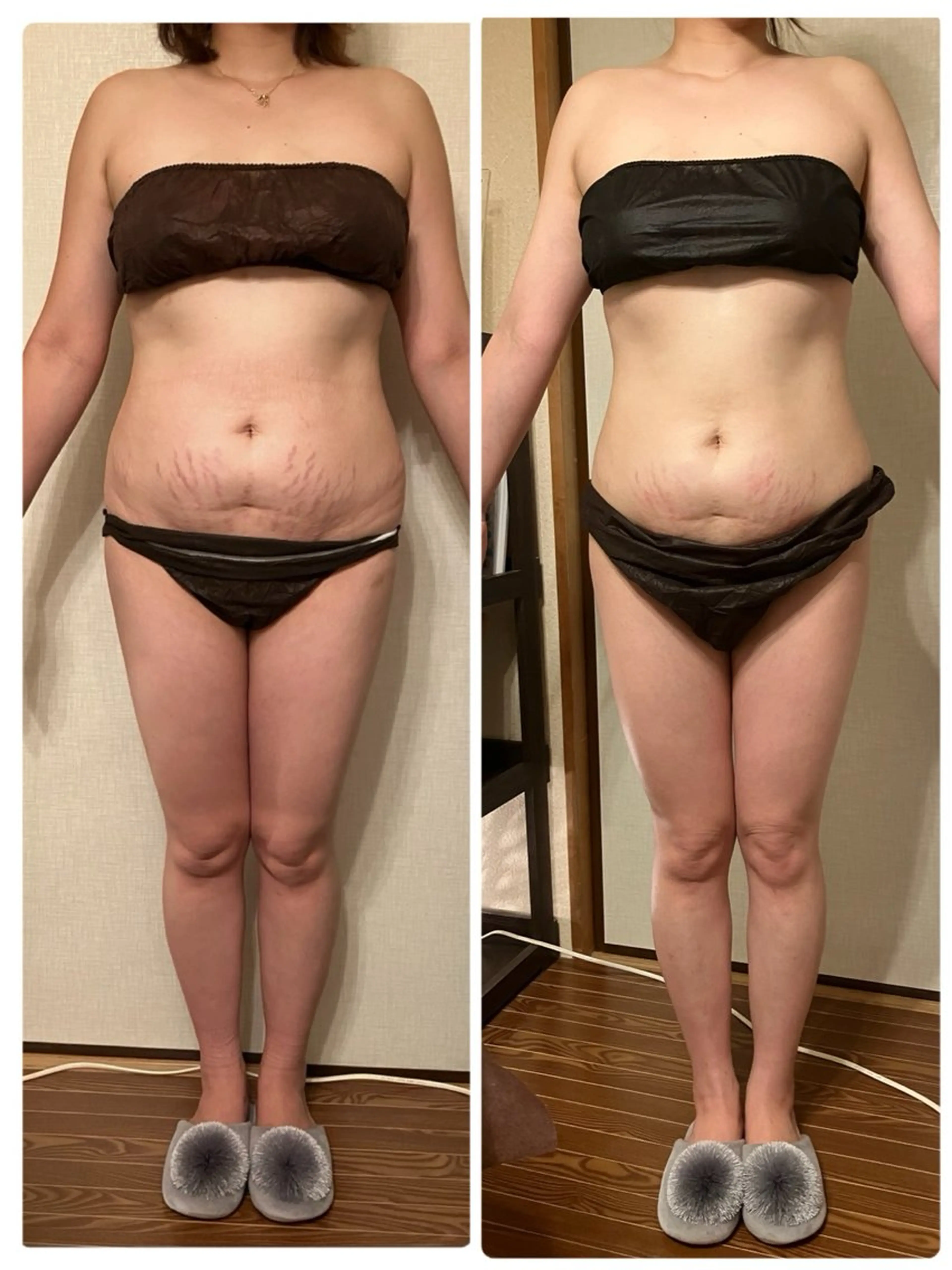 【ラジオ波痩身エステ】全身(顔なし) 排出リンパ＆セルライト潰しの写真