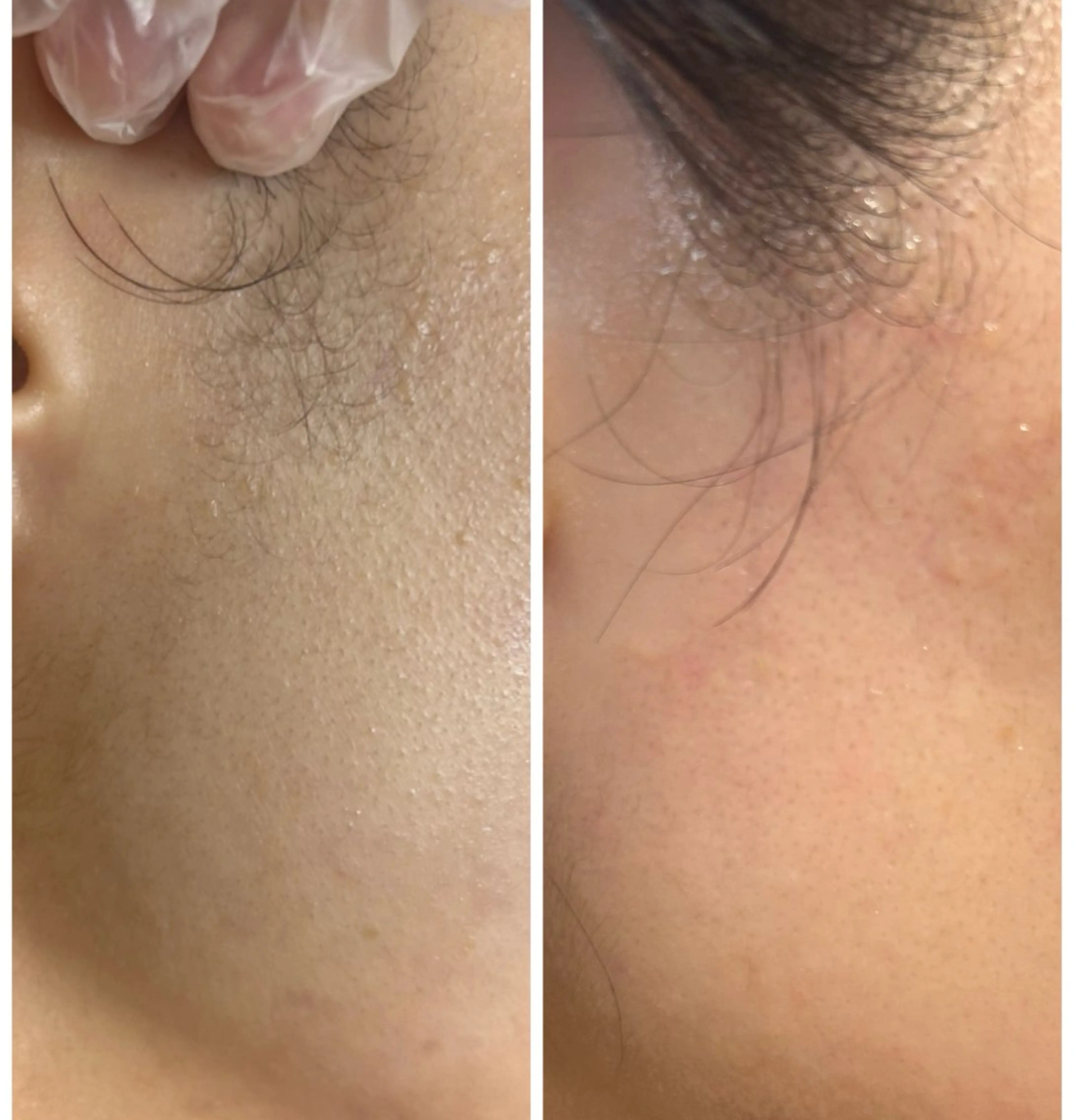 エステ beauty  salon sorelle所属・産毛角質ケア/艶肌 フェイシャルワックスのエステ・リラクイメージ