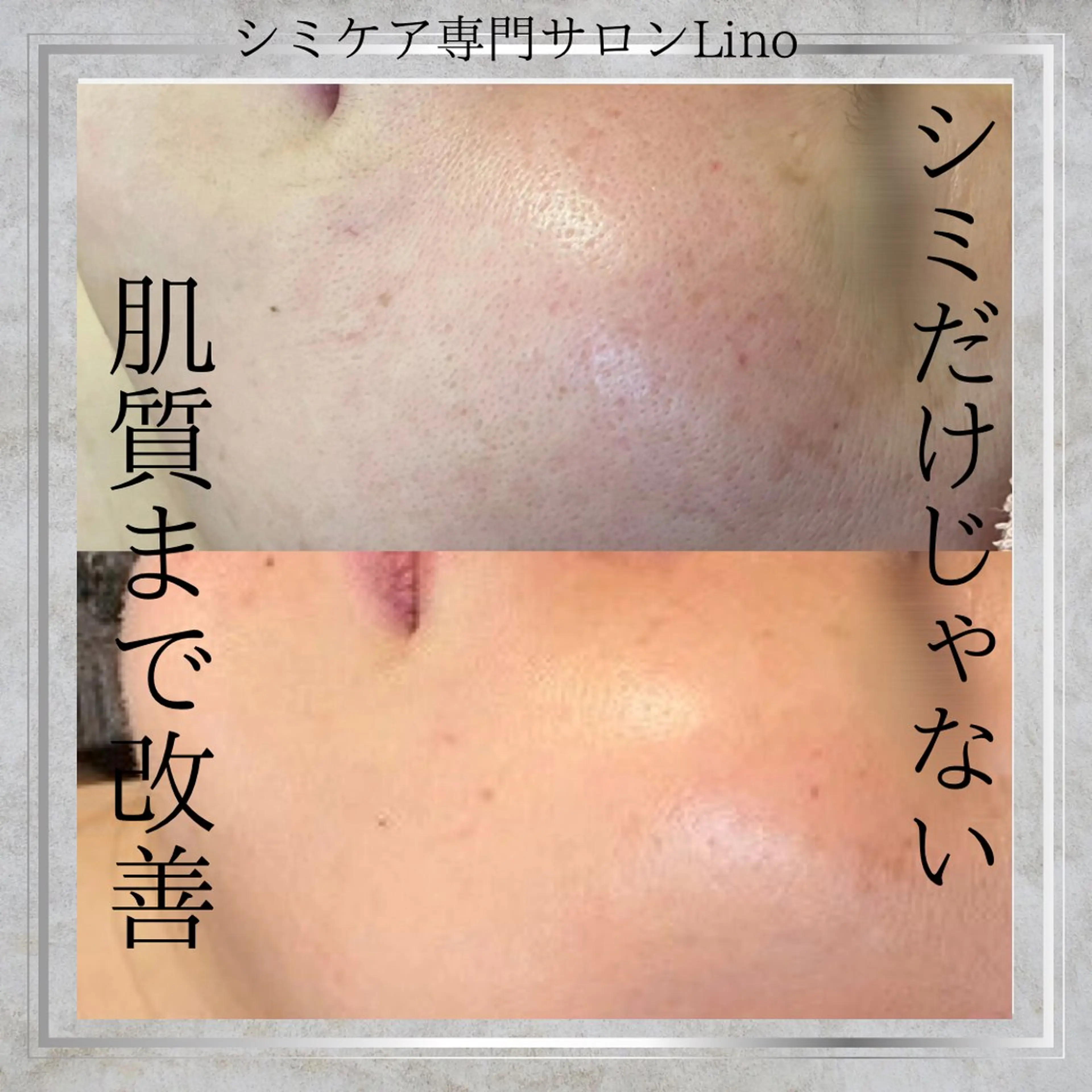 シミケア30分当て放題コースの写真