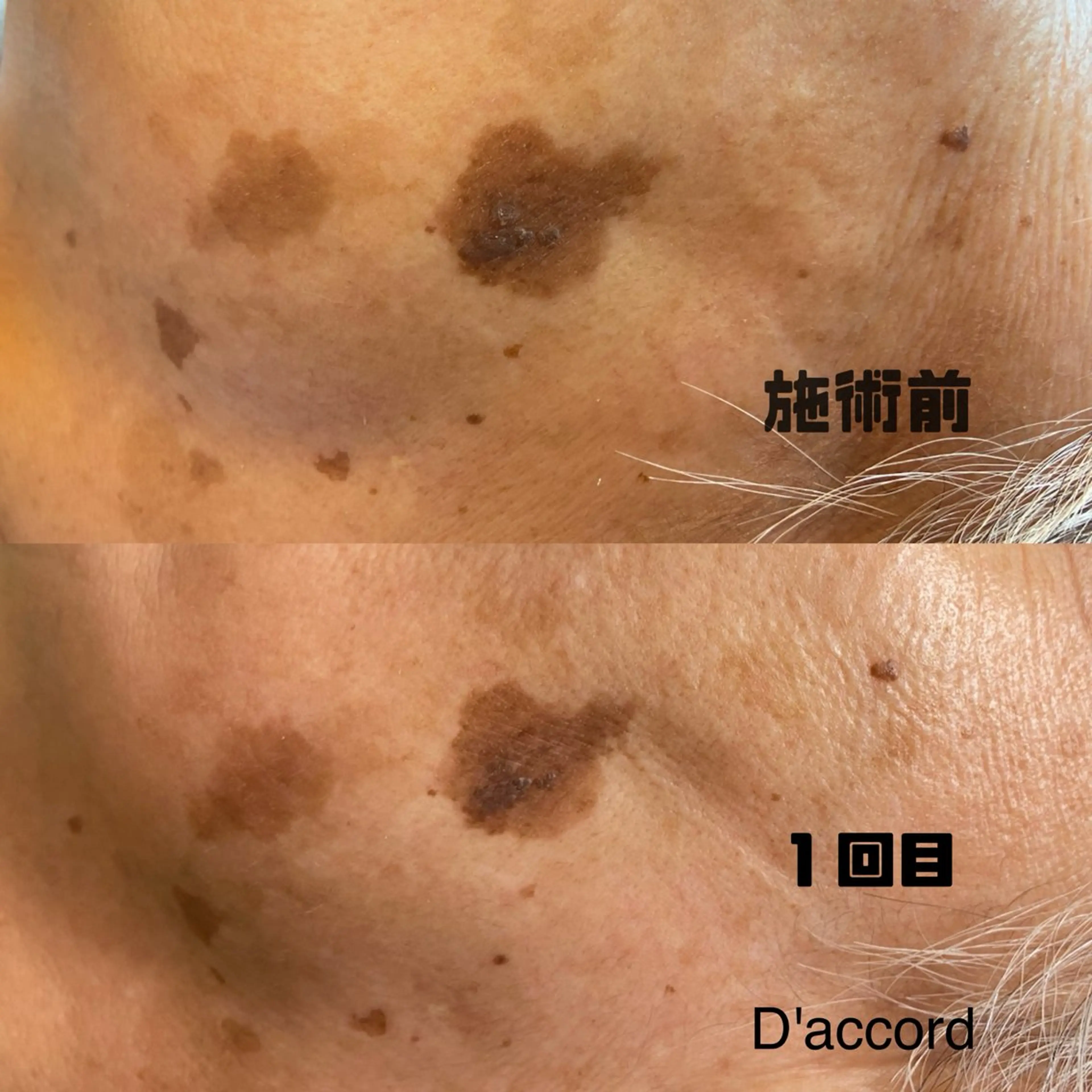 エステ D’accord Rikoのネイルデザイン