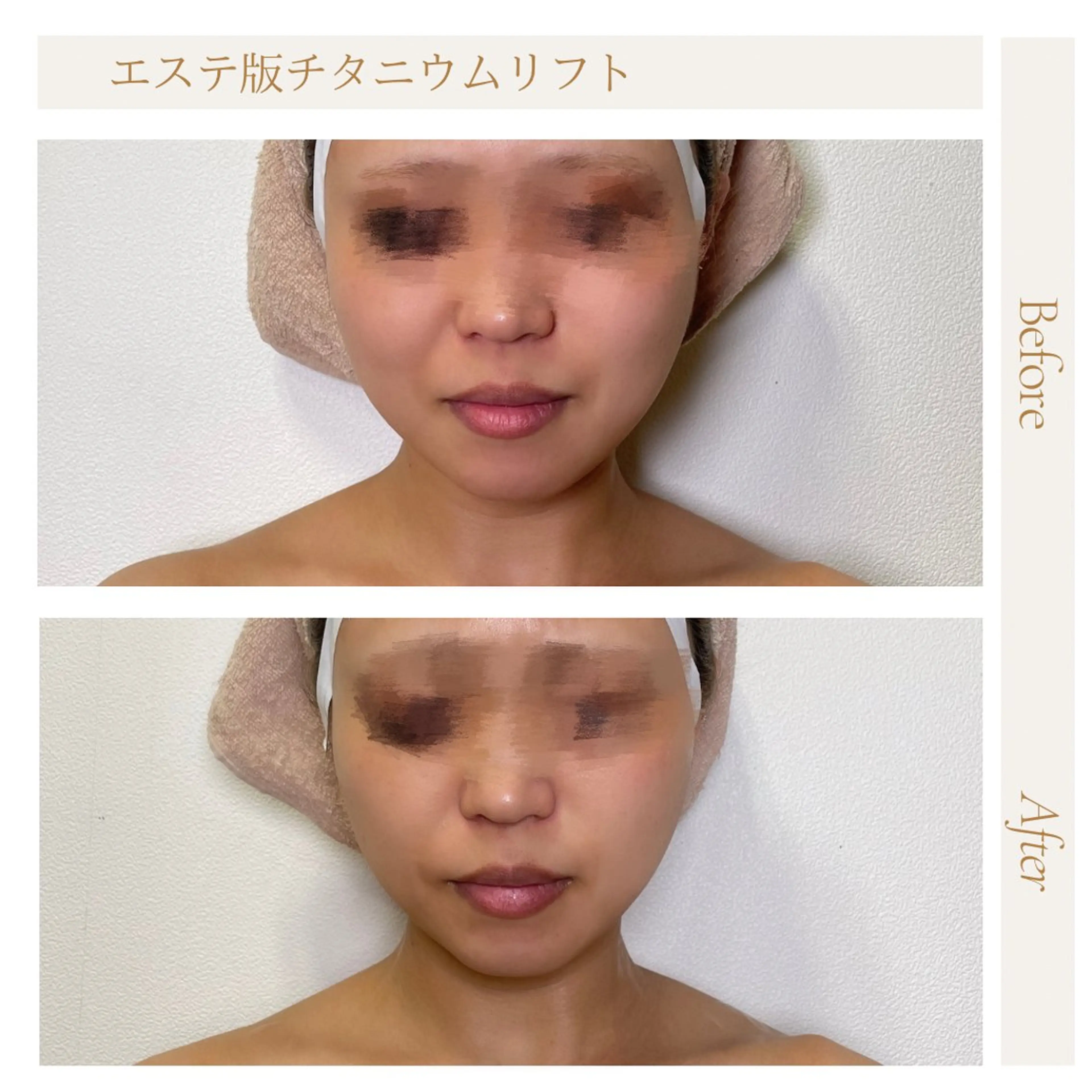 【モニター様限定❗️最新韓国式小顔ケア】エステ版チタニウムリフト¥6,000→¥3,000の写真