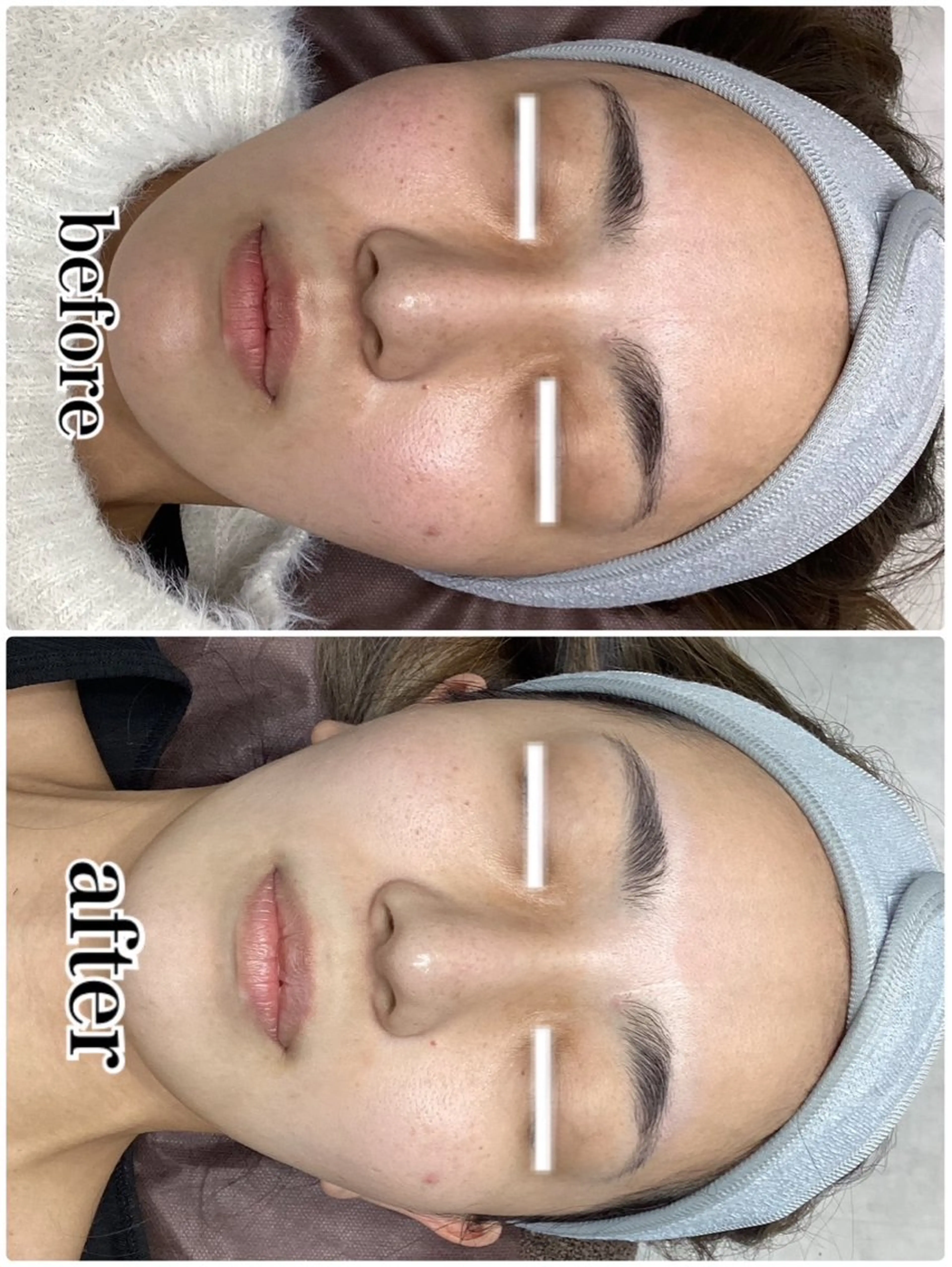 エステ ◯△□所属・最新美肌脱毛 韓国水光肌🫧のその他イメージ