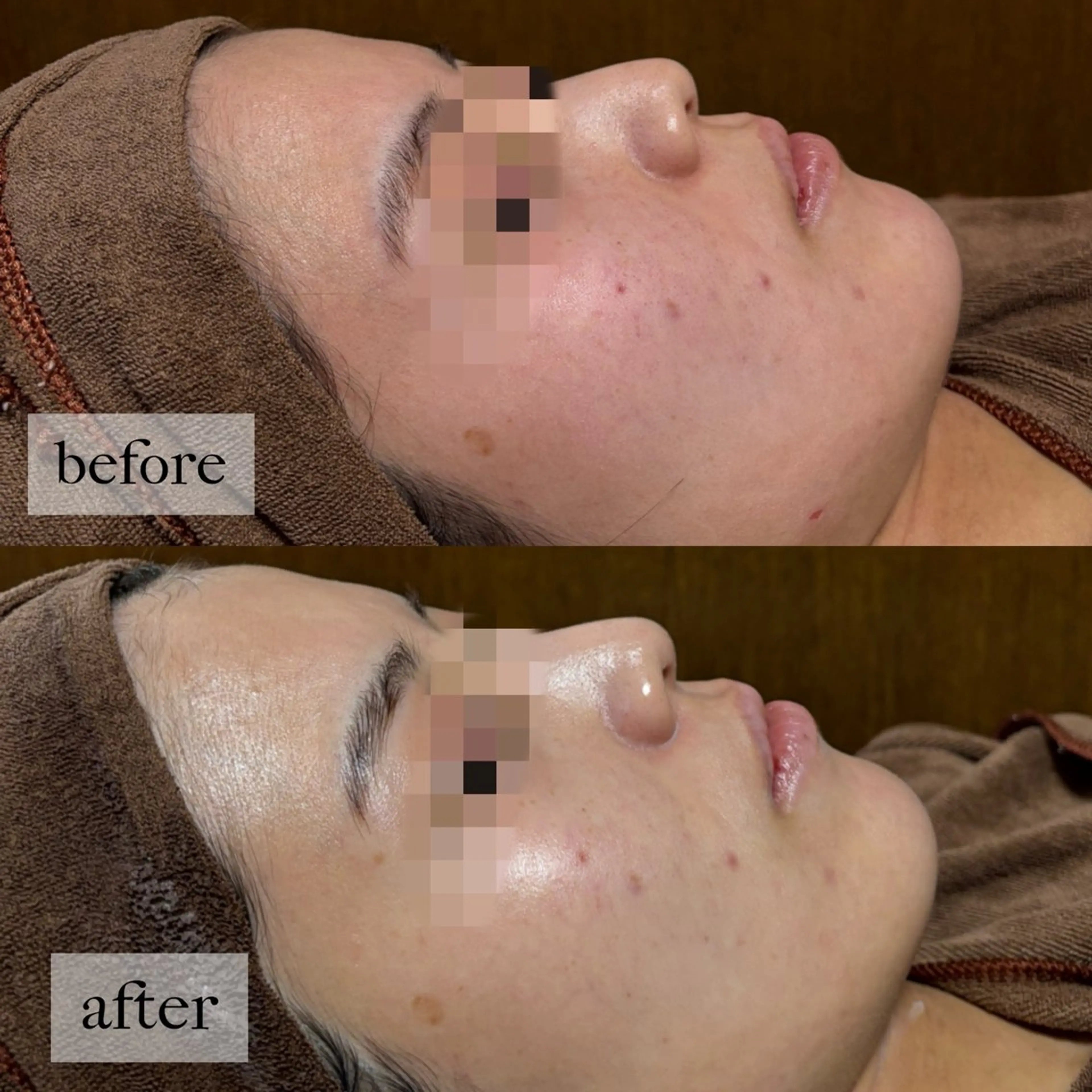 エステ HINANO矢場町店【ヒナノ】所属・脱毛/肌改善🌿 HINANO 村田のエステ・リラクイメージ