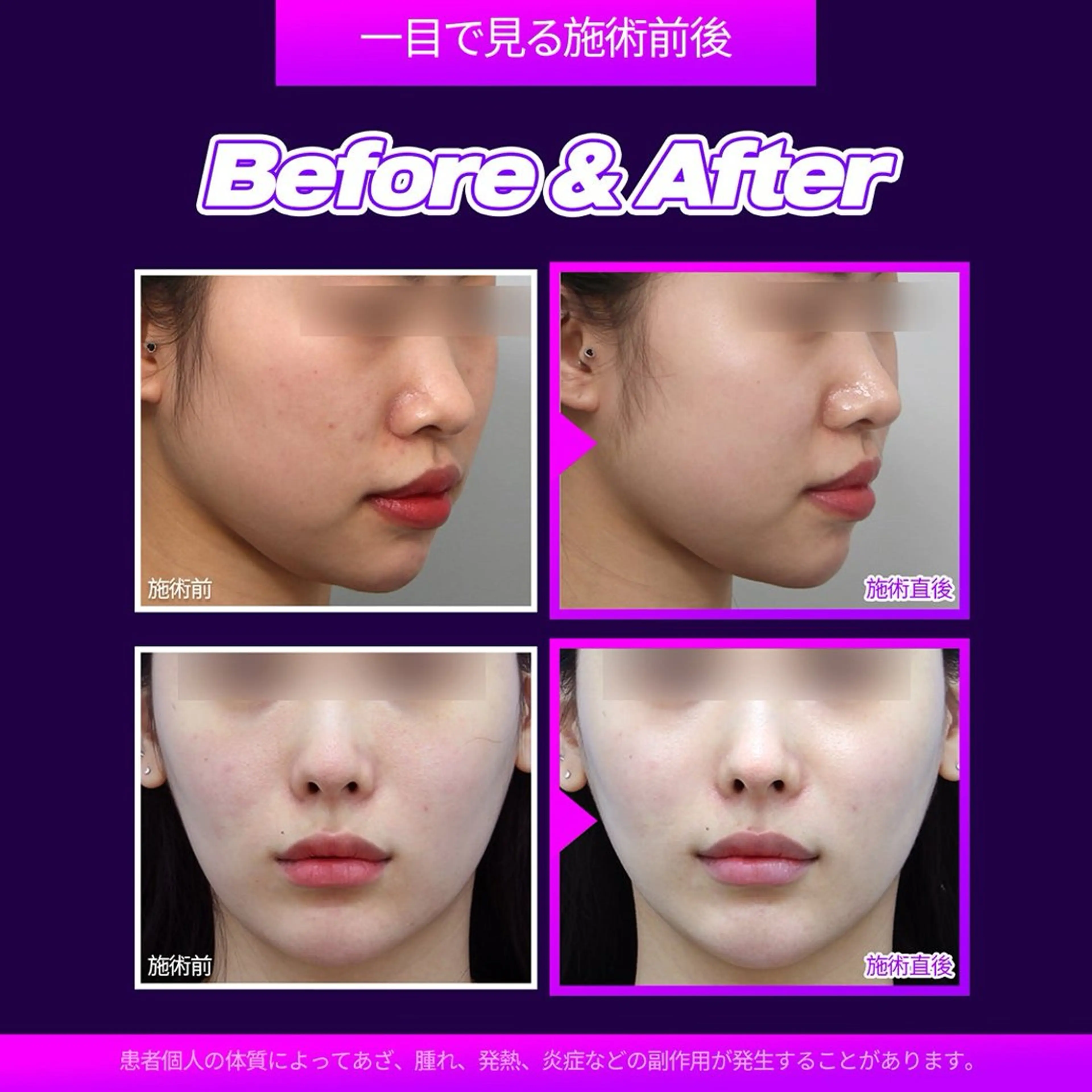 ハーブピーリング/韓国肌管理/フェイシャル/毛穴洗浄/眉毛/顔脱毛【糸脱毛専門】rev所属・ハーブピーリング🌹 毛穴洗浄❤️眉waxのエステ・リラクイメージ