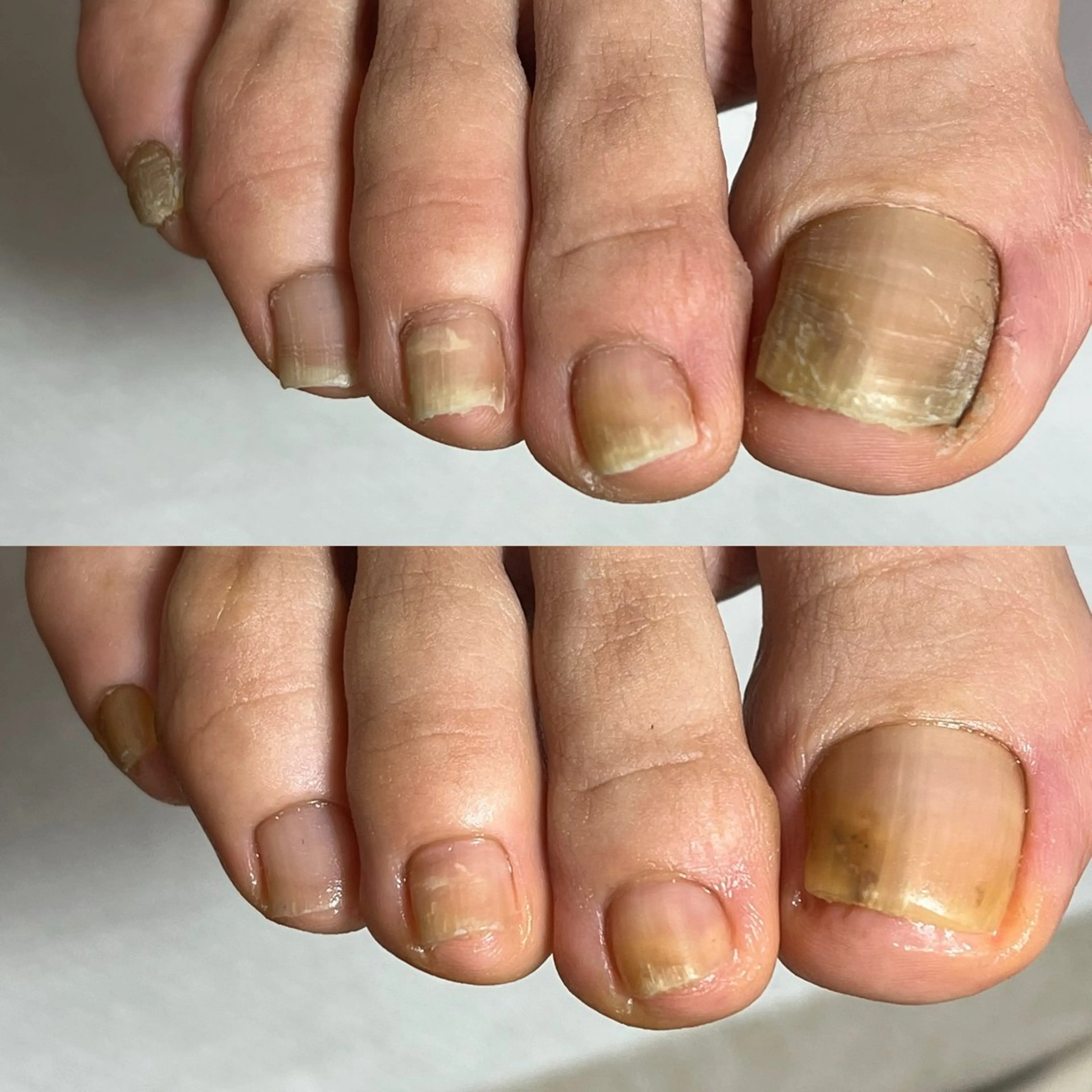 【フットケア】足の爪切り＋甘皮角質ケアの写真