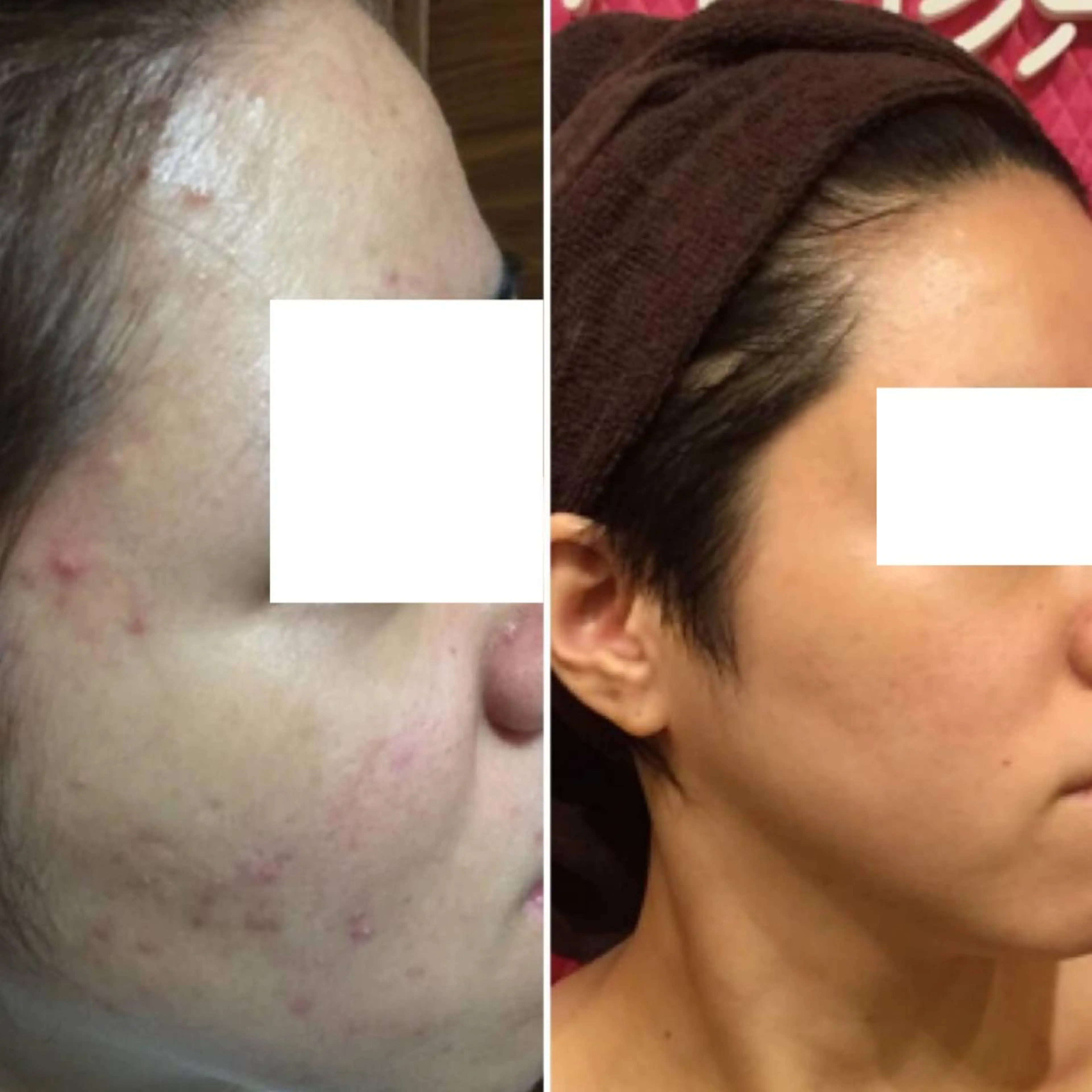 ネイル マツエク・マツパ ニキビ・毛穴改善 🌿ハーブピーリングのエステ・リラクイメージ