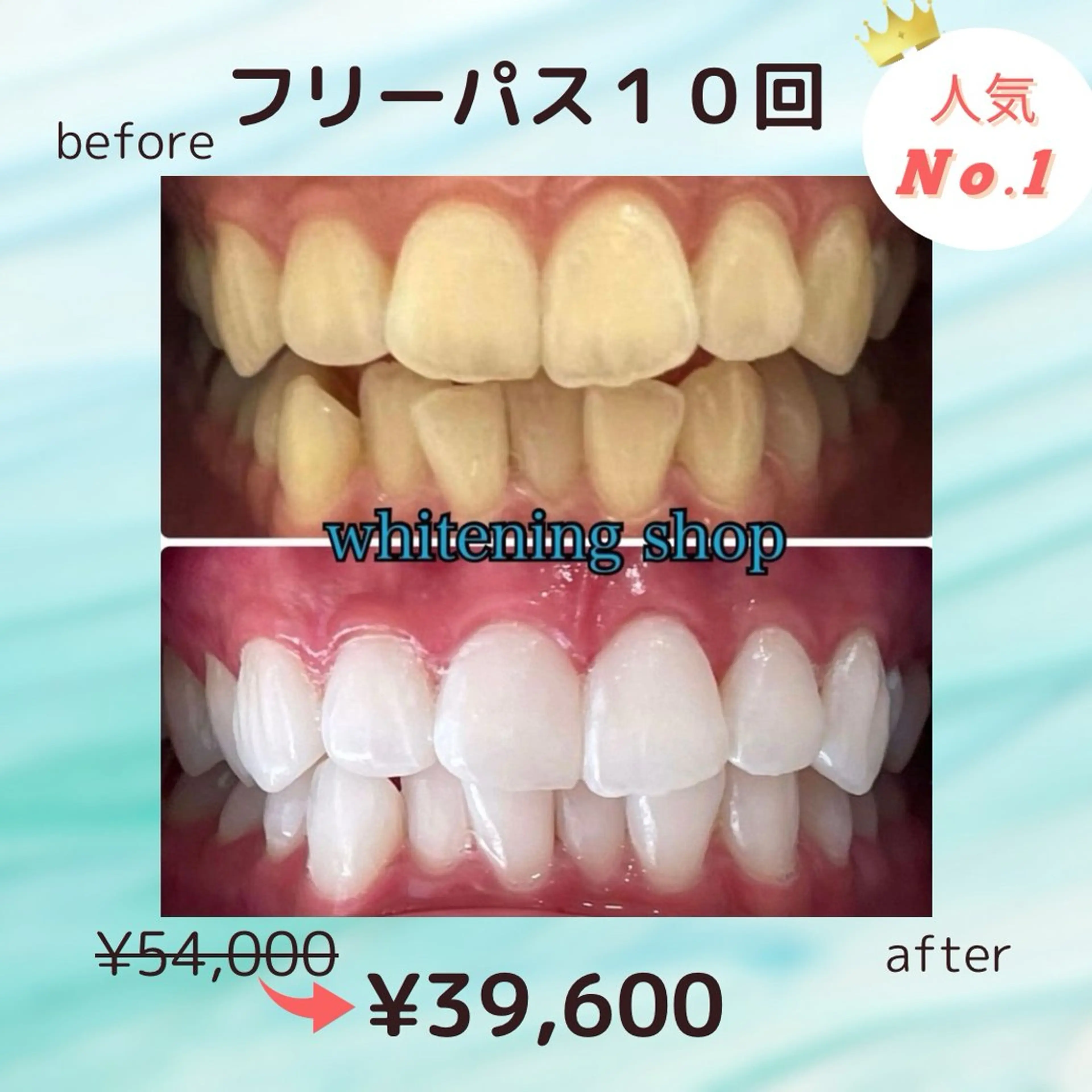 💎人気No. 1👑フリーパスコース💎美白セルフホワイトニング💎20分x20回照射¥54,000→¥39,600の写真