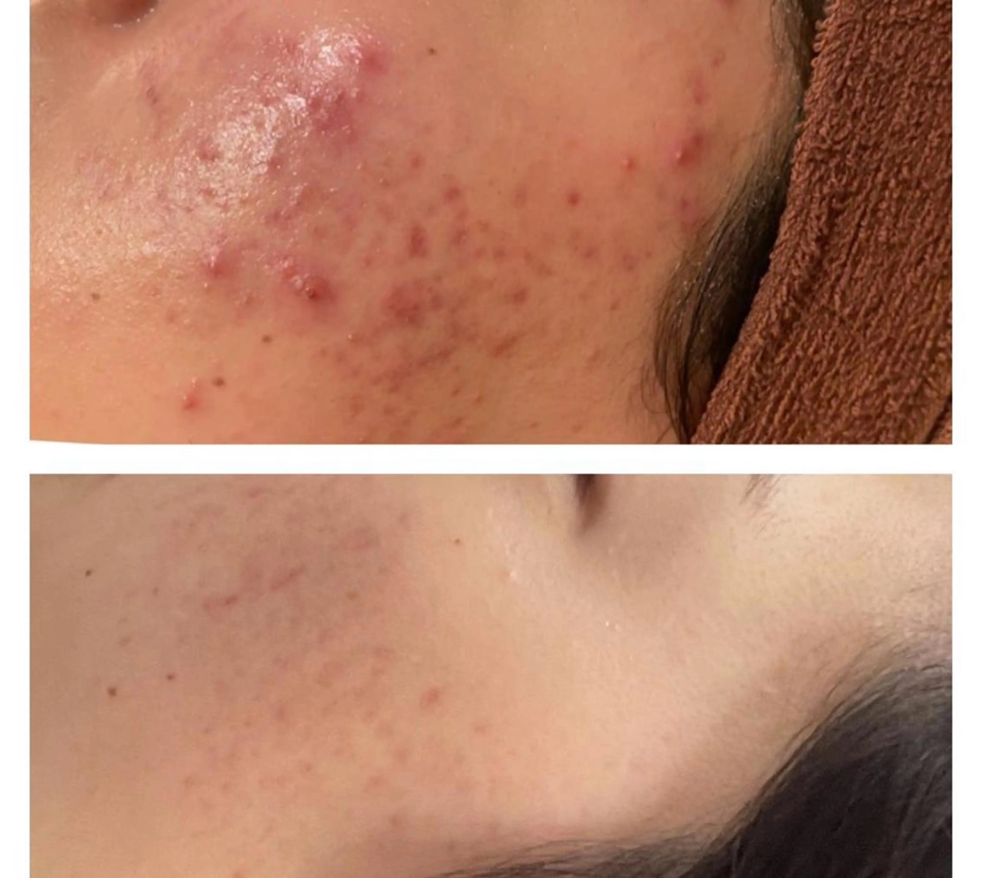 セミロング カラー パーマ ヘアアレンジ メンズ キッズ ネイル マツエク・マツパ アイブロウ その他 ニキビ特化型エステ 🍓最短で肌質改善のエステ・リラクイメージ