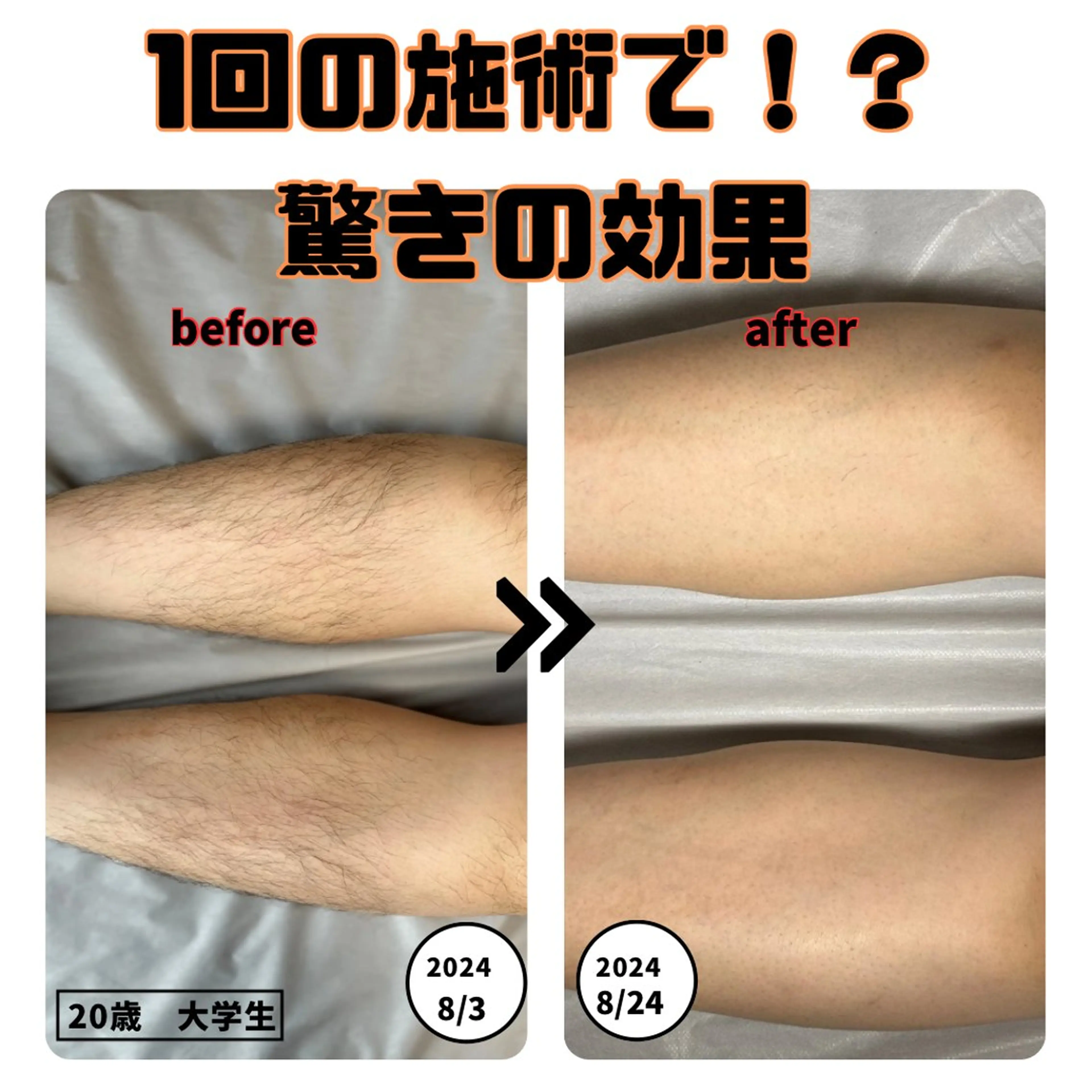 【学生限定】両脚脱毛8,800円→2,200円‼️※メンズ脱毛の写真