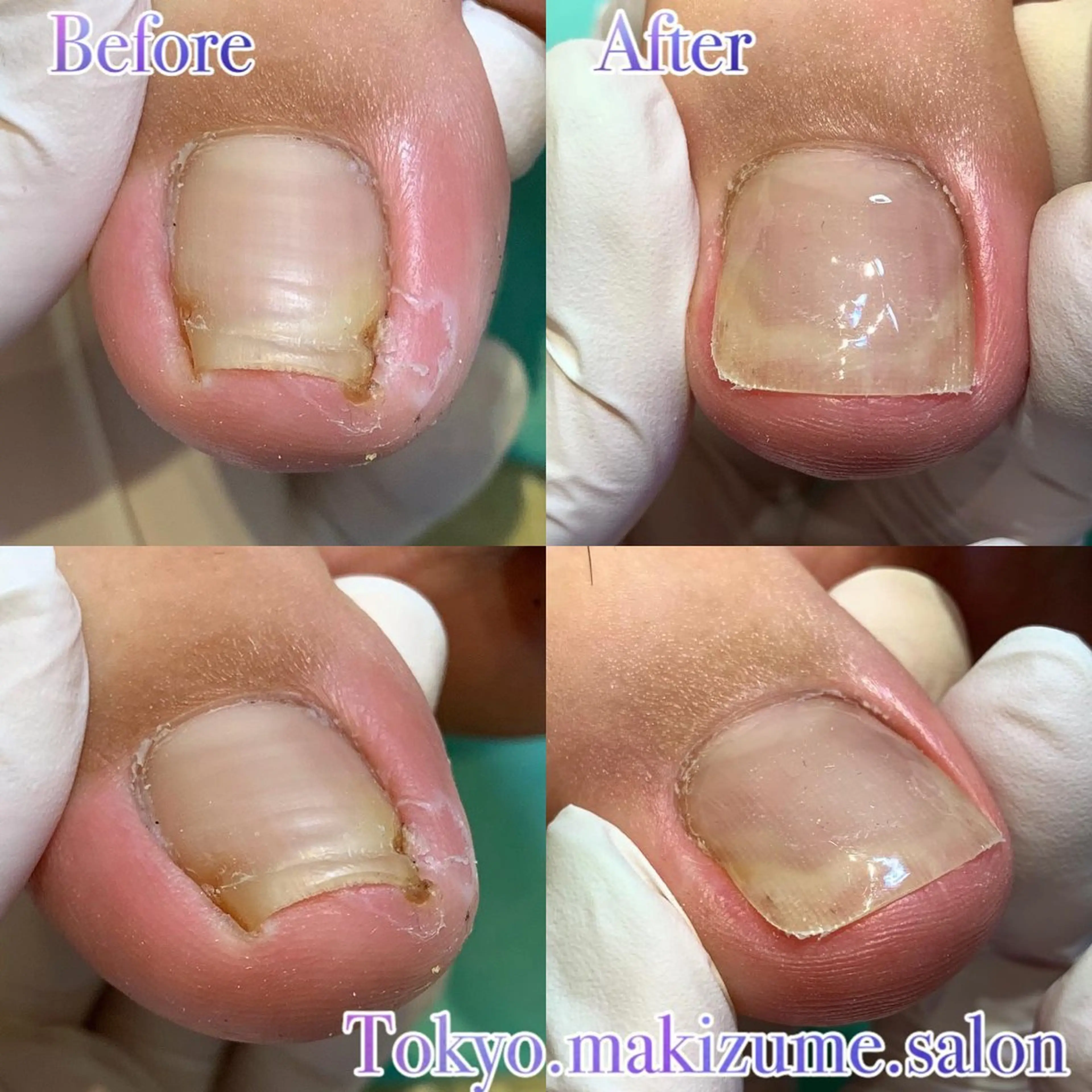 【陥入爪補正】１か所の巻き爪補正✨皮膚に沈み込んだ爪も矯正器具でキレイに再生✨生活の痛みや違和感を改善致します💡の写真