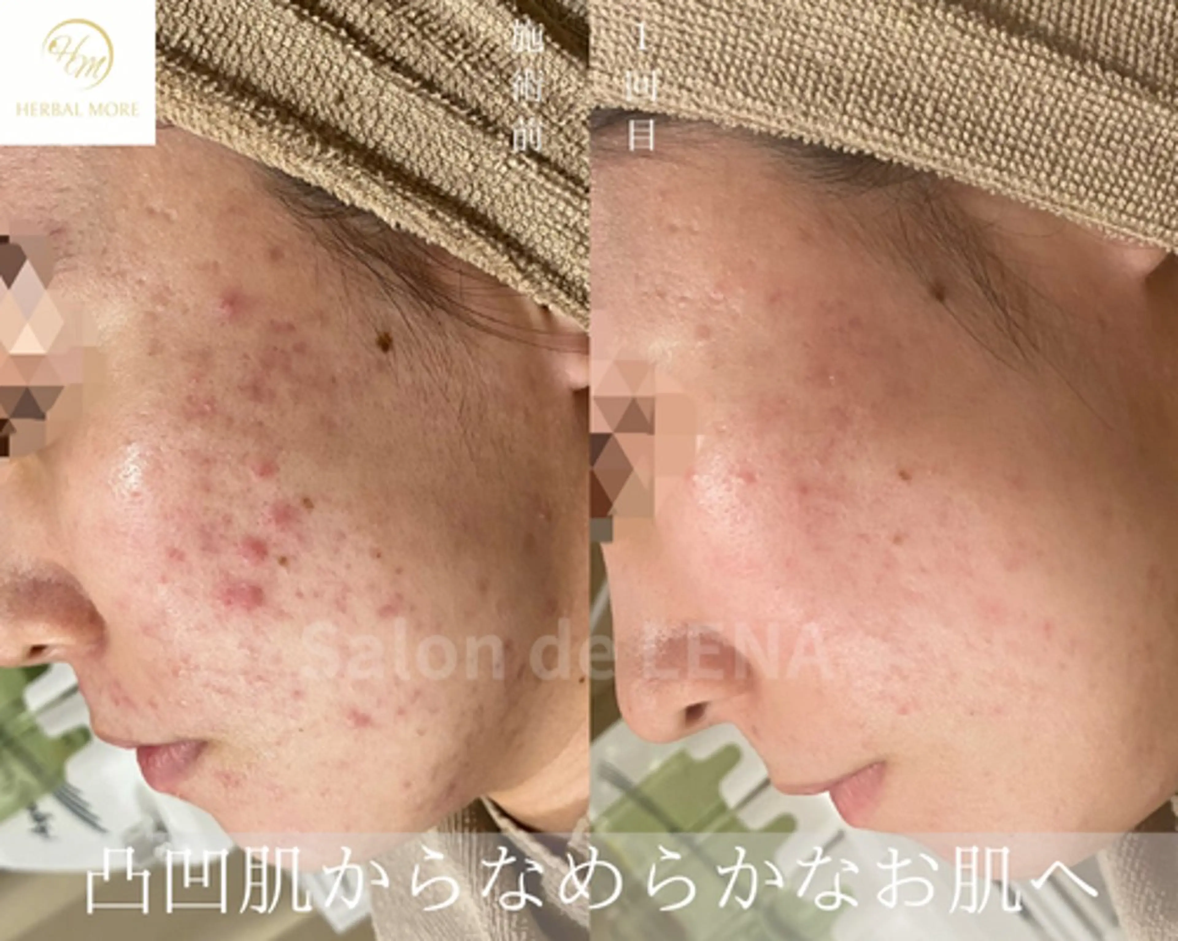 サロンドレナ名駅店所属・ハーブピーリング専門 サロンドレナ平岡のエステ・リラクイメージ